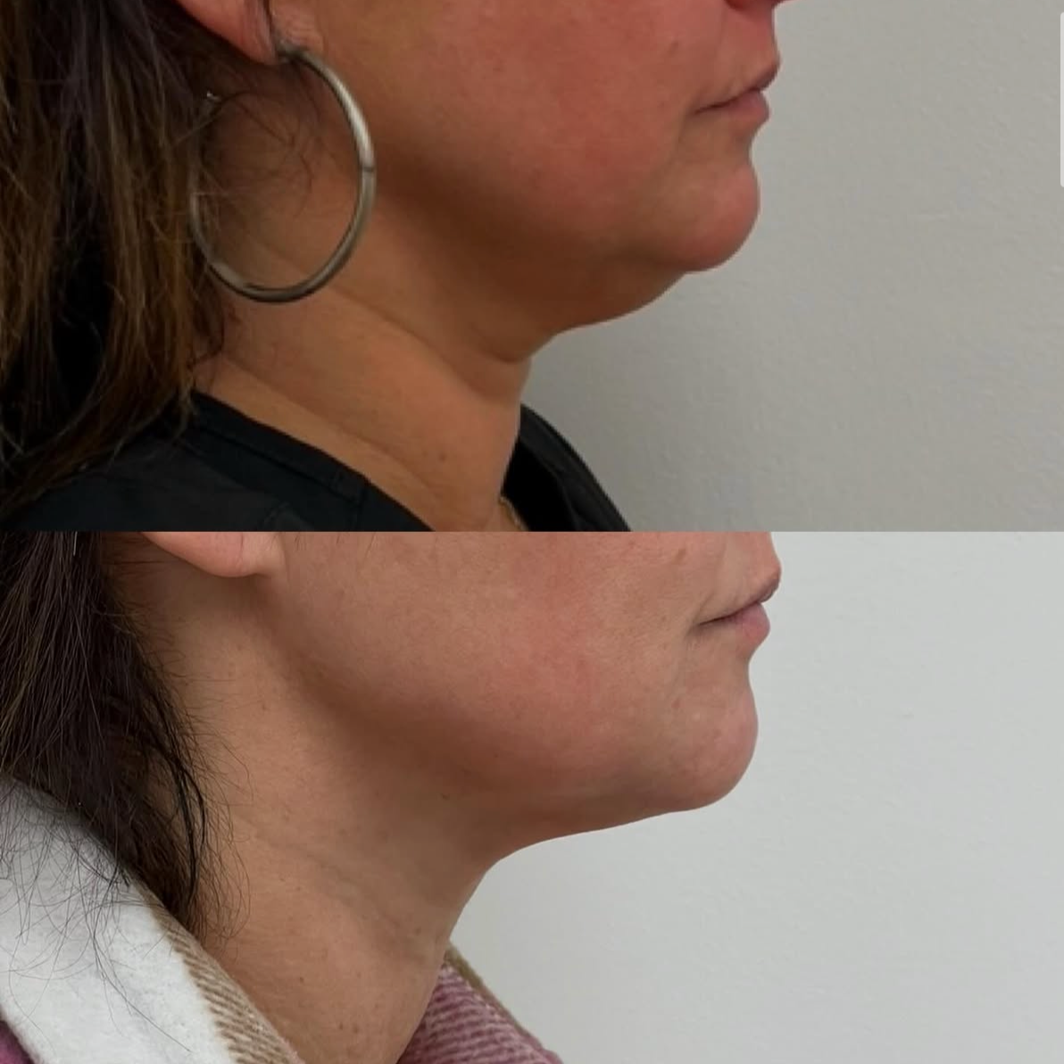Comparison of side profile of a woman's face, showing a before and after of a cosmetic procedure to reduce the neck and jawline area.
