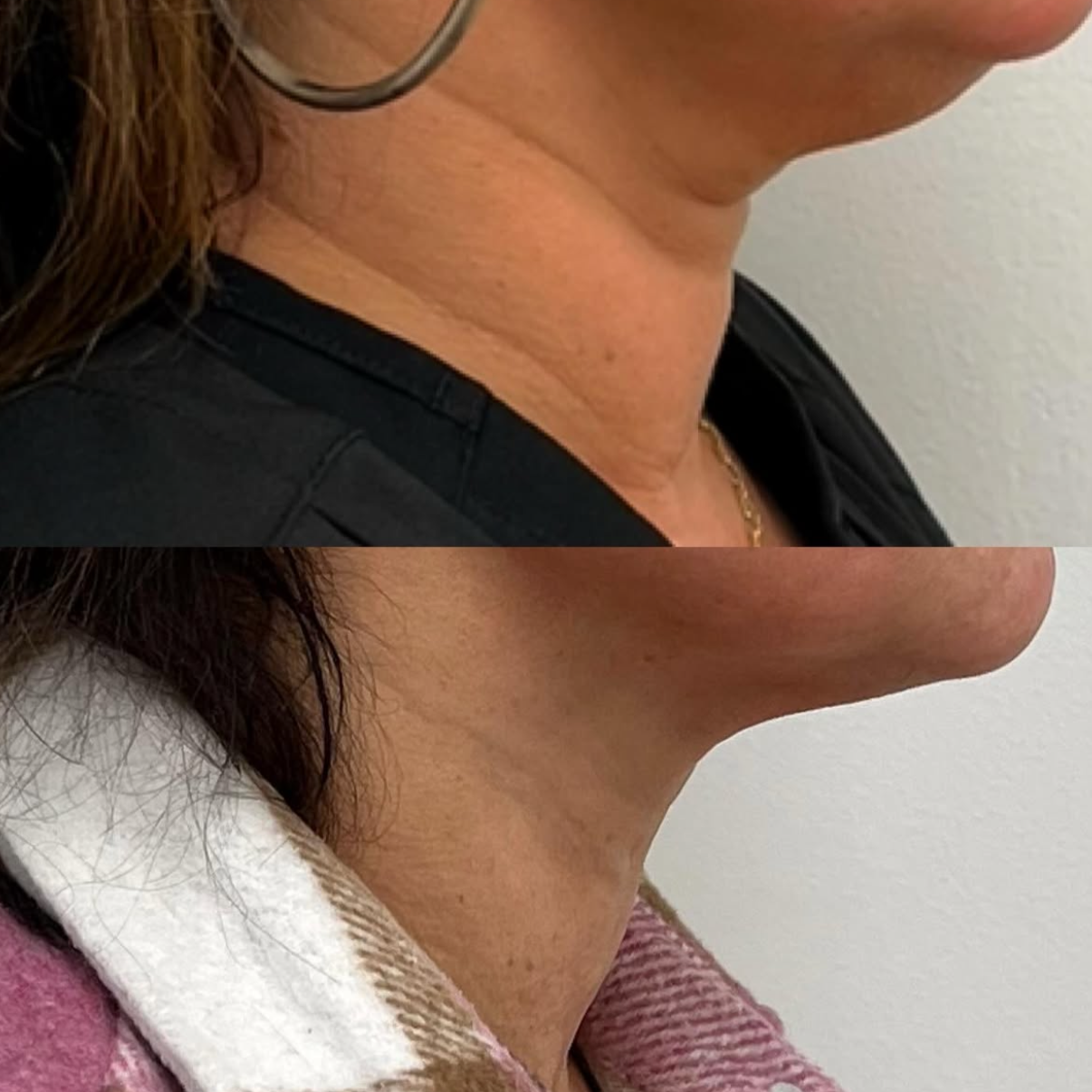 Comparison of neck skin, showing improved skin tightness and reduced wrinkles in the lower part of the image, with the upper part displaying looser skin.