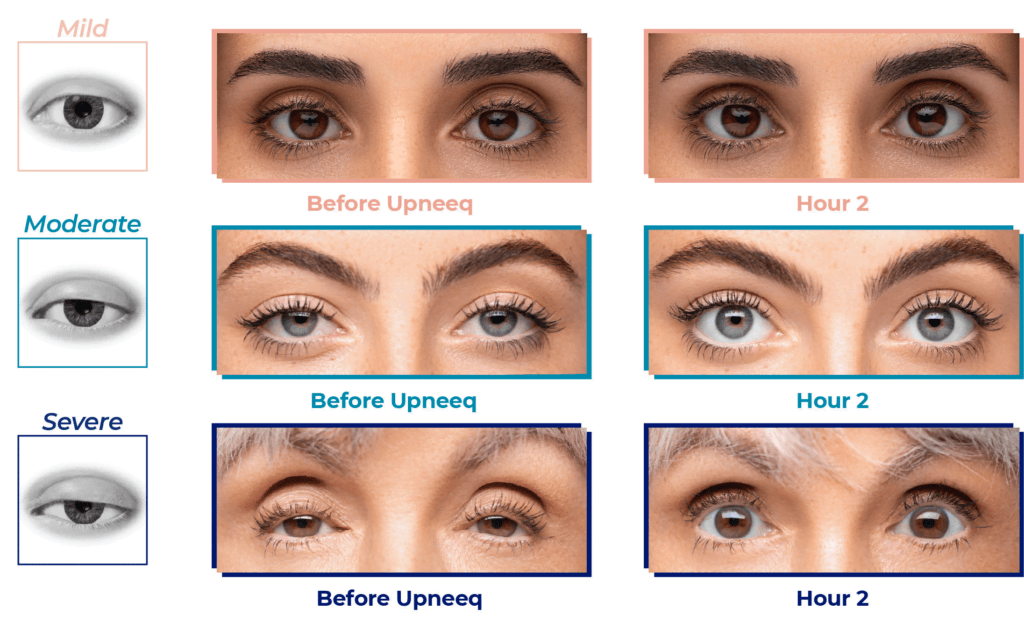 Comparison showing the effects of Upneeq on eyelid elevation, with images of mild, moderate, and severe ptosis before and two hours after using the medication.