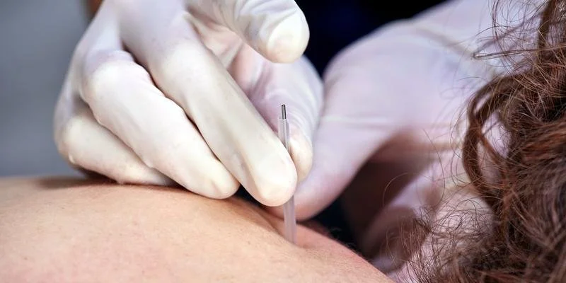 What Is Dry Needling? 