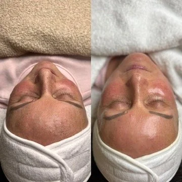 Aqua Facial Behandlung