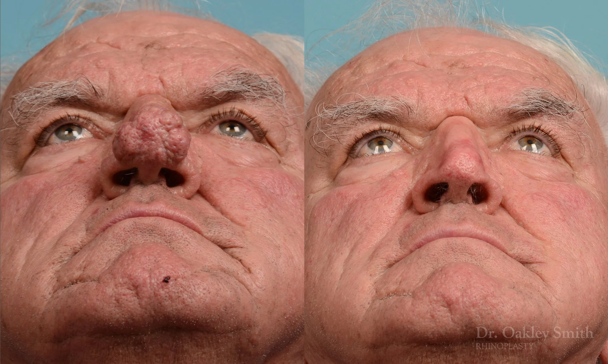 245F-rhinophyma-nose-job-rhinoplasty-dr-oakley-smith-toronto-1.jpg