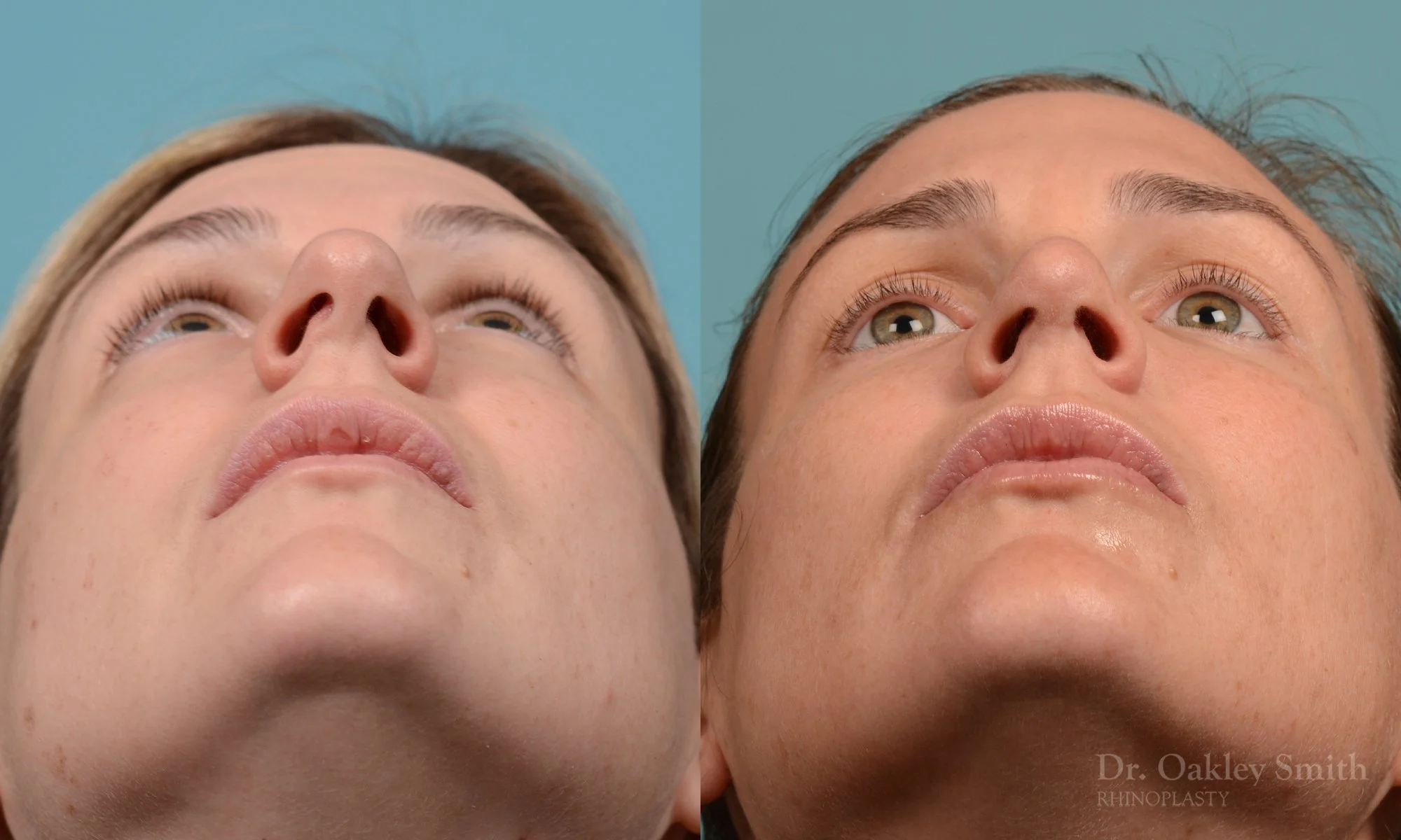 312F-rhinoplasty-dr-oakley-smith-toronto-nose-job.jpg