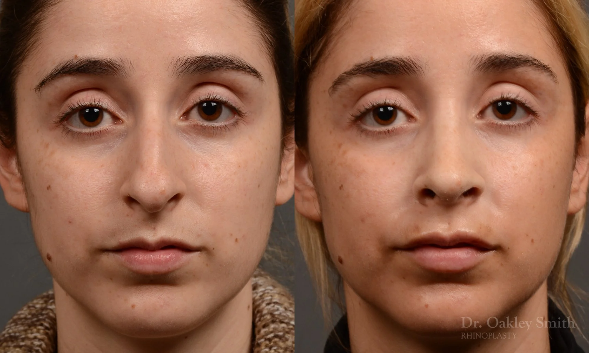 286A-rhinoplasty-dr-oakley-smith-toronto-nose-job.jpg