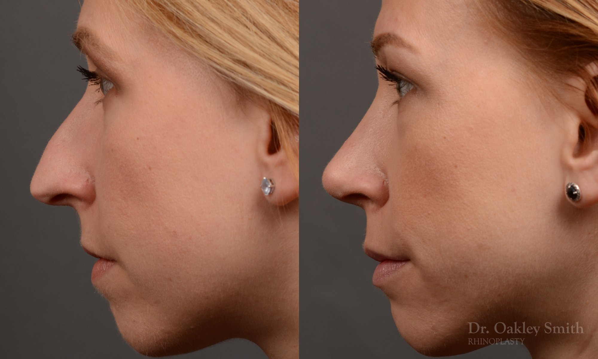 363.2E-rhinoplasty-dr-oakley-smith-toronto-nose-job.jpg