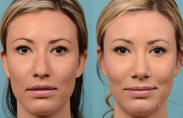199: Female Rhinoplasty, Dorsal Hump, Tip Narrowing Refinement