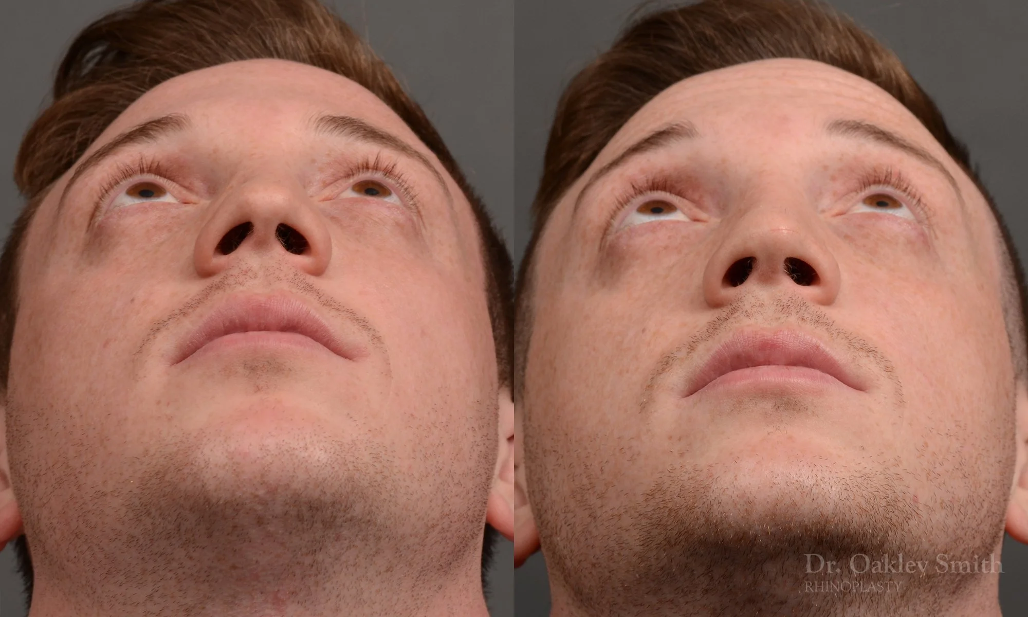 339.1F-rhinoplasty-dr-oakley-smith-toronto-male-nose-job.jpg
