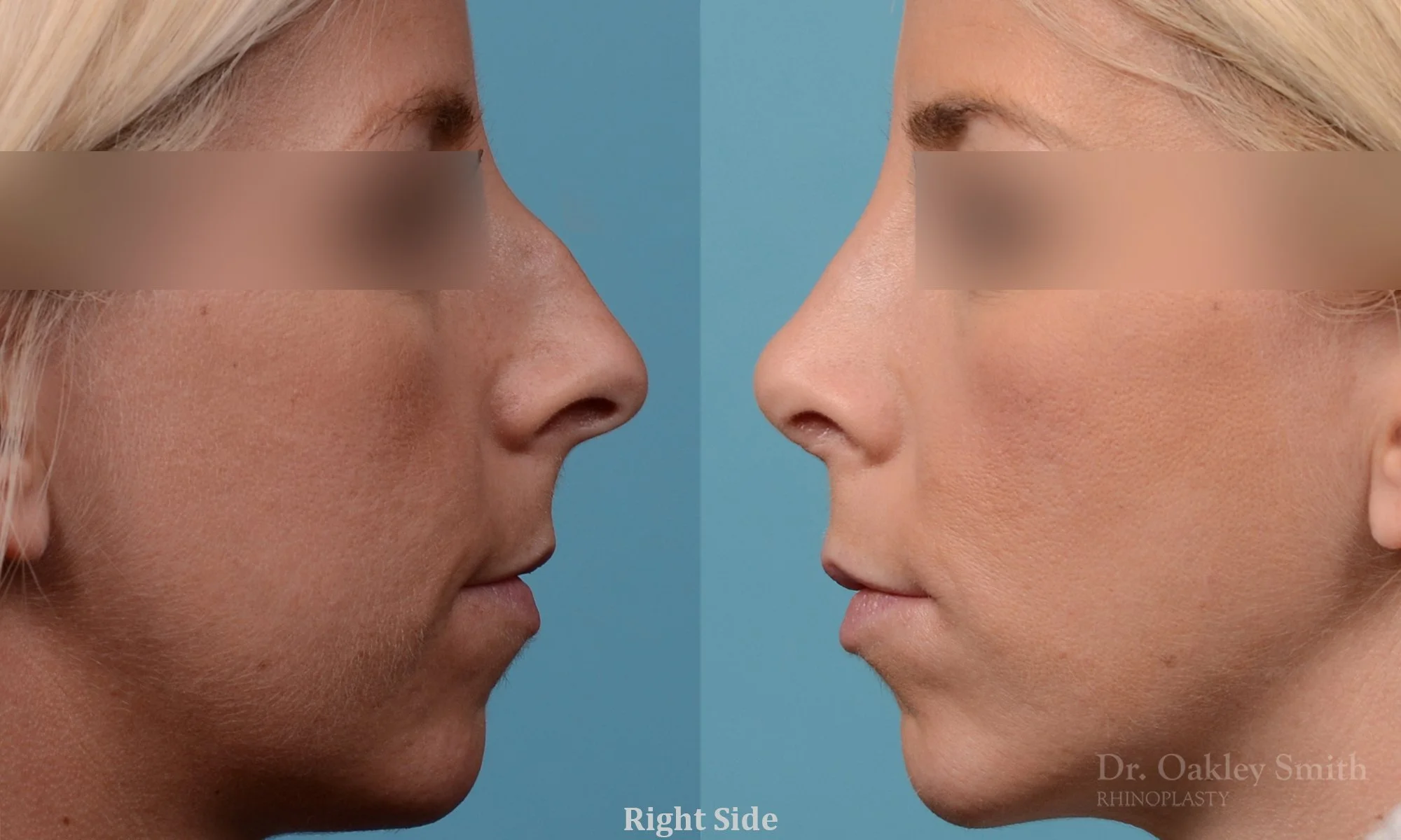 242: Female, Primary Rhinoplasty, Thin Skin, Dorsal Bump, Tip Rotation