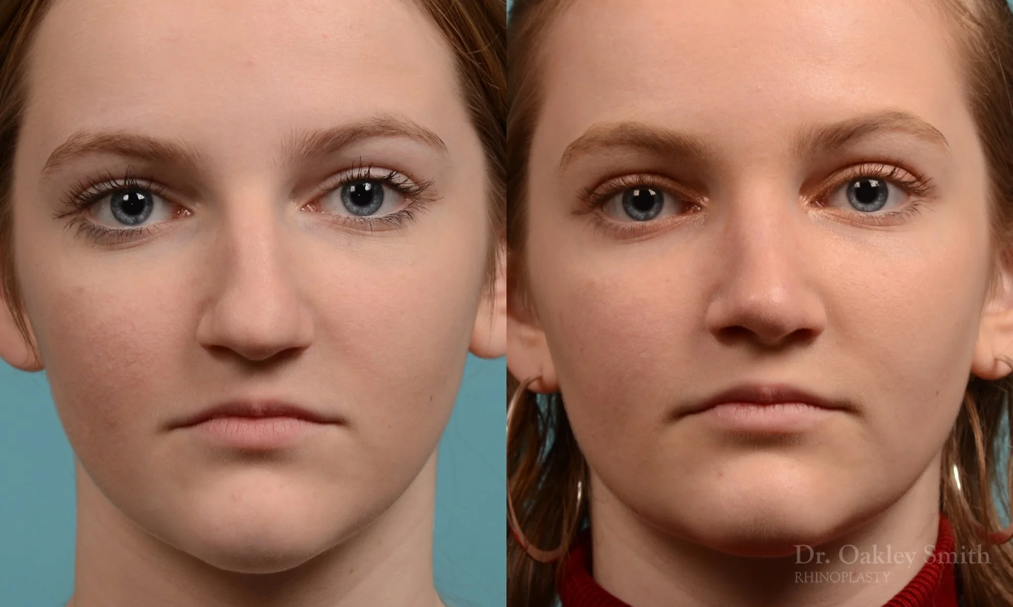 314A-rhinoplasty-dr-oakley-smith-toronto-nose-job.jpg