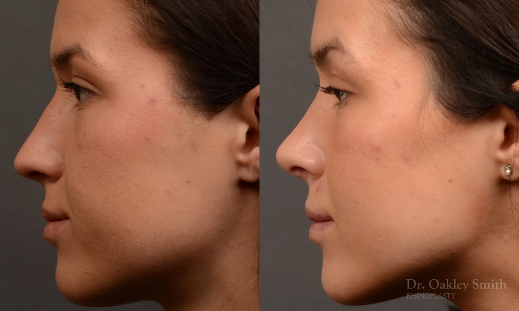 549E-rhinoplasty-nose-job-toronto-nose-surgeon-dr-oakley-smith.jpg
