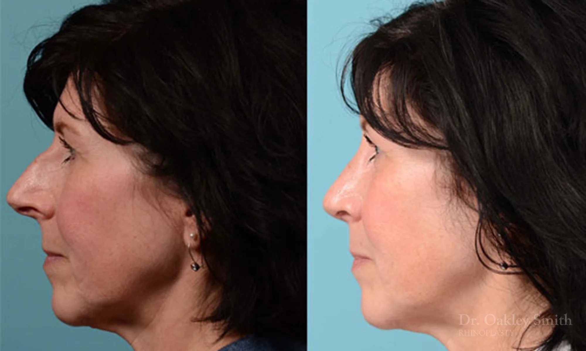 324D-rhinoplasty-dr-oakley-smith-toronto-nose-job.jpg