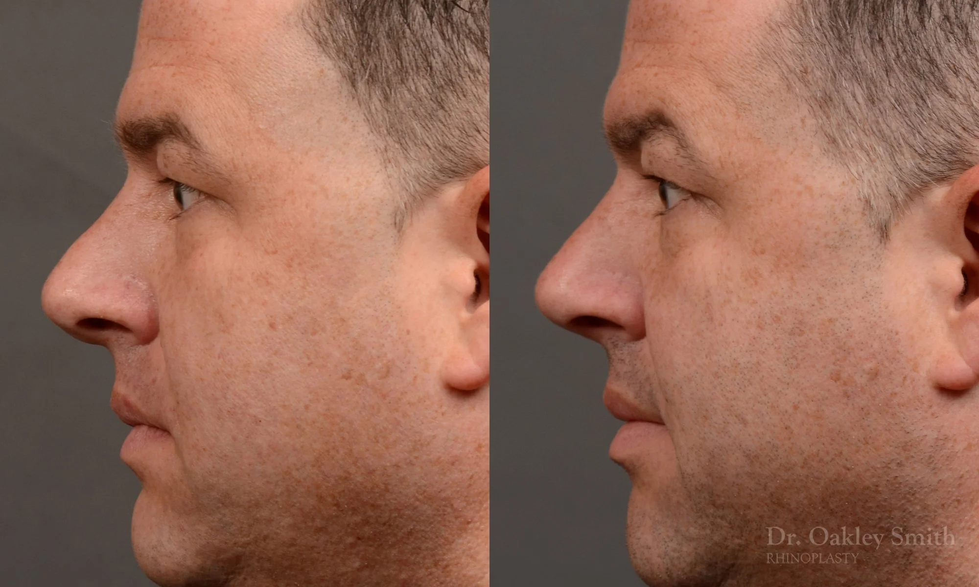 514E-male-rhinoplasty-dr-oakley-smith-toronto-nose-job.jpg