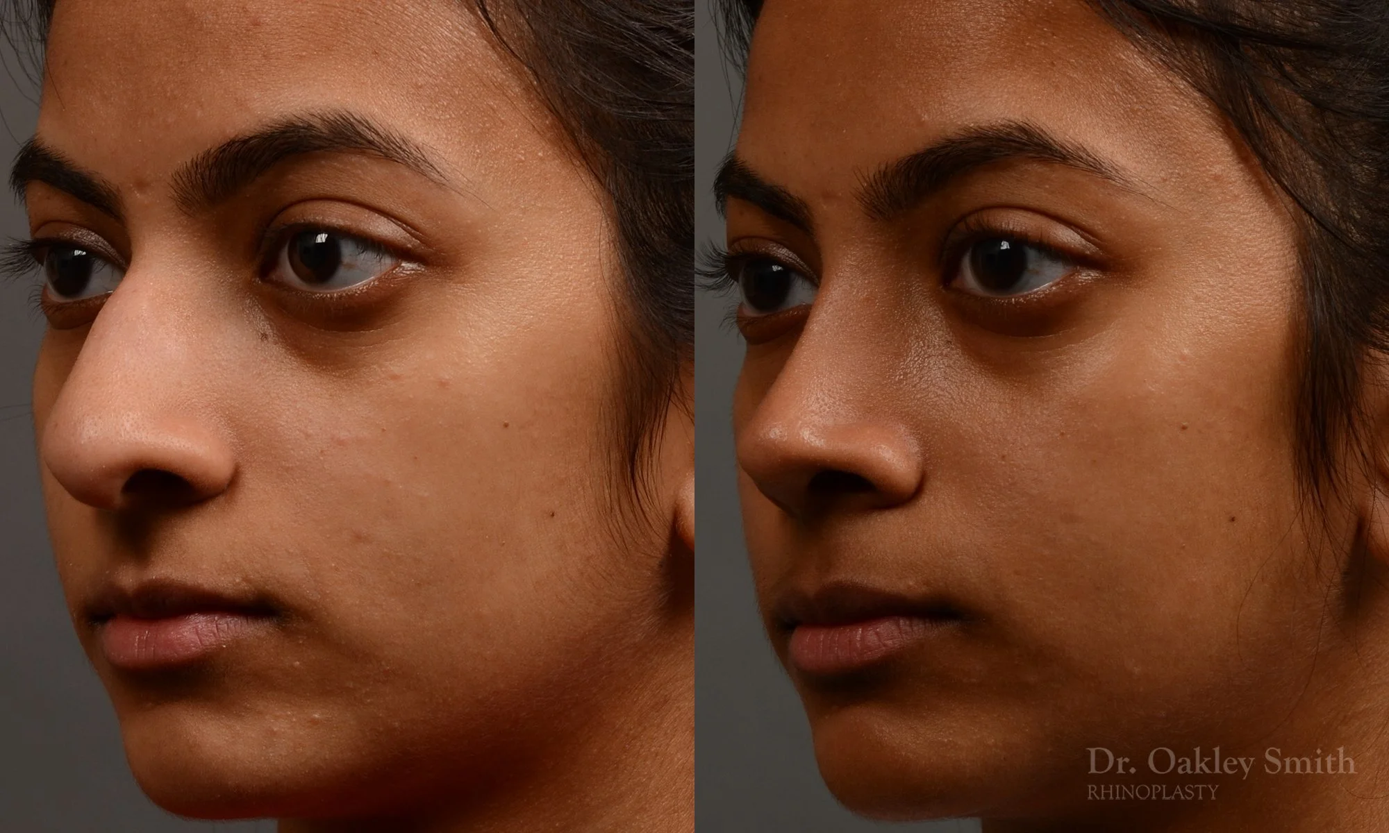 399D-expert-rhinoplasty-dr-oakley-smith-toronto-nose-job.jpg