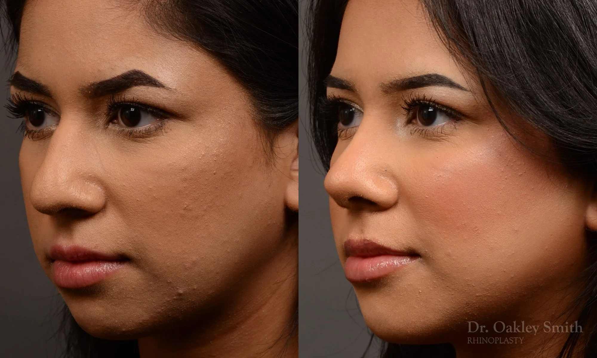 Case 557 Dr. Oakley Smith, preservation rhinoplasty, 12 months after surgery, left oblique view
