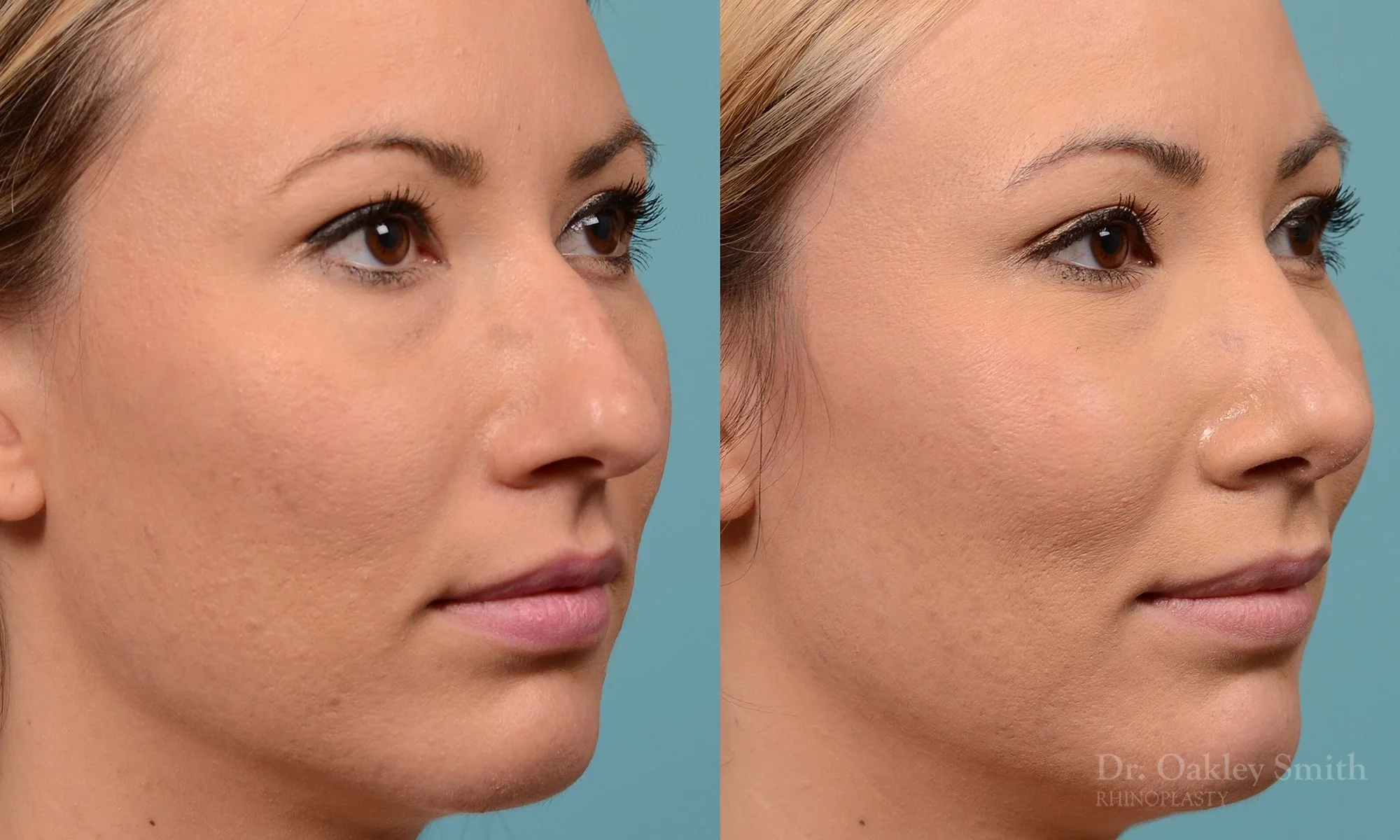 213B-rhinoplasty-toronto-dr-oakley-smith-big-nose-nose-job-curved-straight-profile-columellar-raised-1.jpg