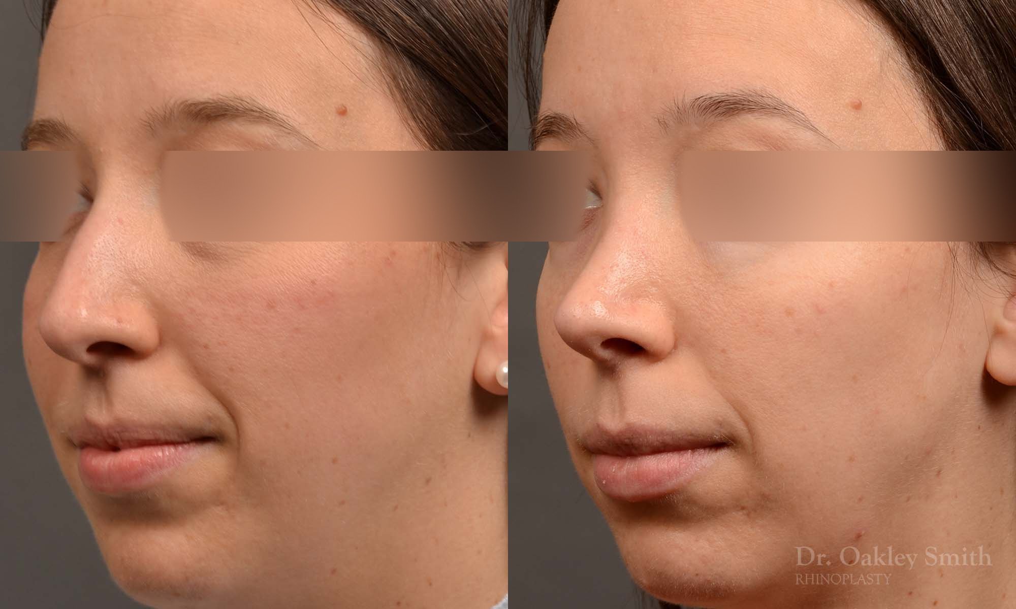 534D-rhinoplasty-dr-oakley-smith-toronto-top-surgeon-nose-job.jpg