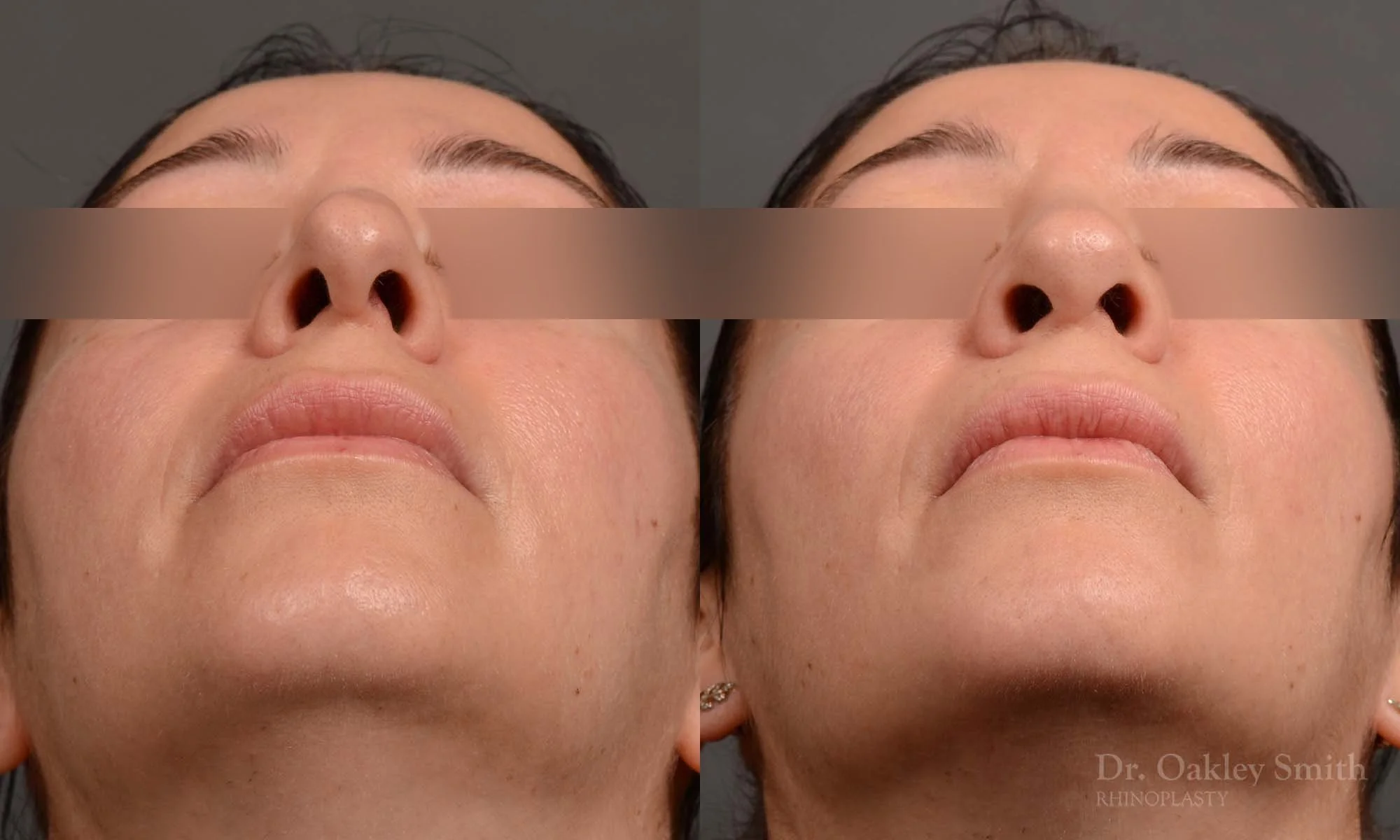 331F-rhinoplasty-dr-oakley-smith-toronto-nose-job (1).jpg