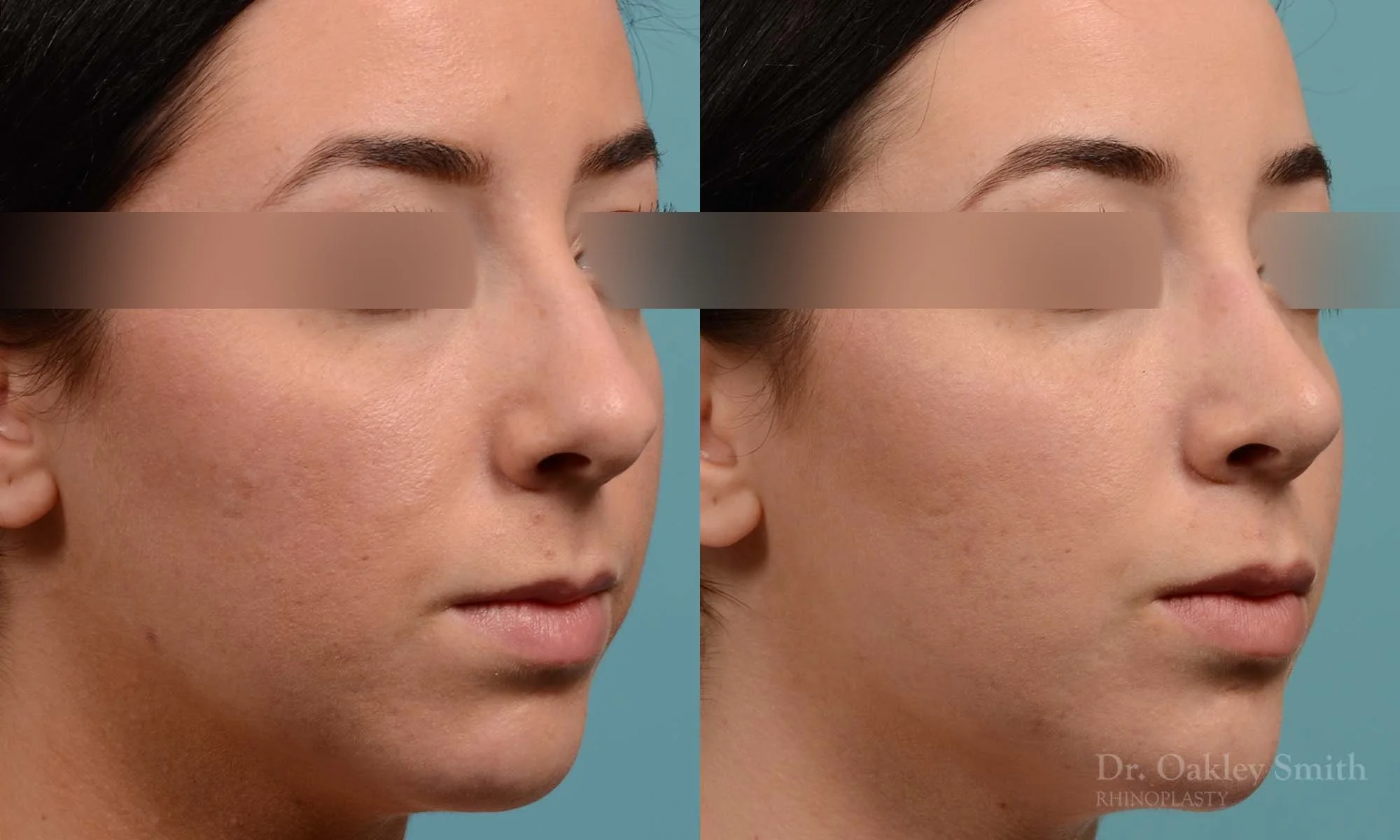 283B-rhinoplasty-dr-oakley-smith-toronto-nose-job.jpg