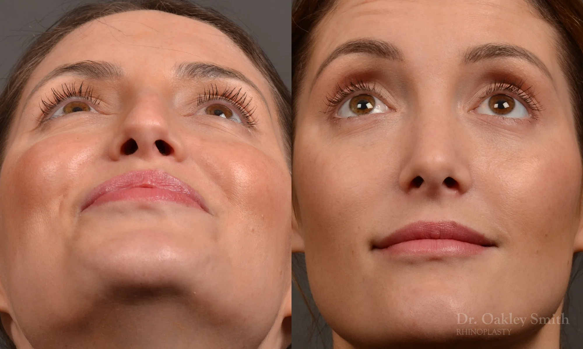 490F-rhinoplasty-dr-oakley-smith-toronto-top-surgeon-nose-job.jpg