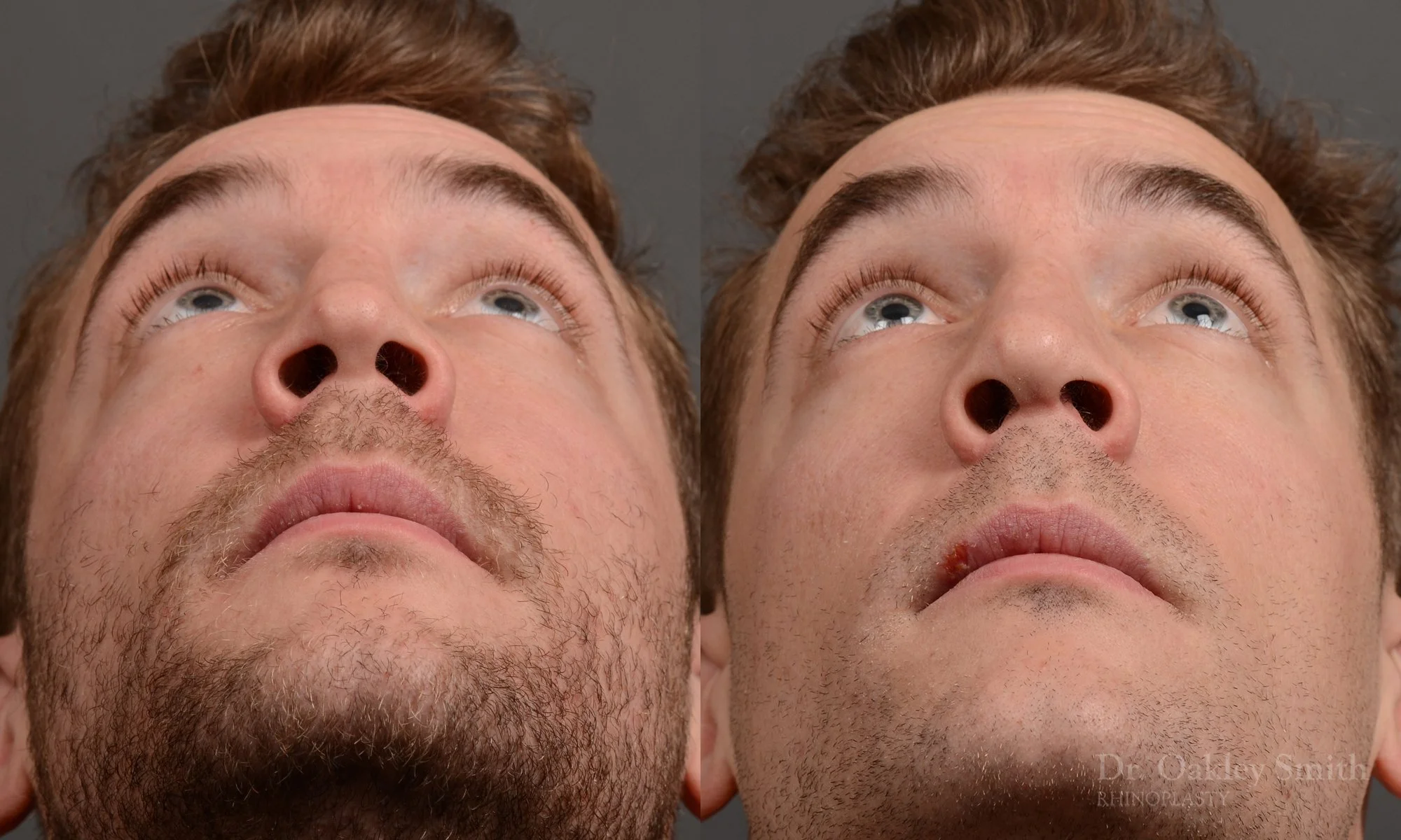 388F-rhinoplasty-dr-oakley-smith-toronto-nose-job.jpg