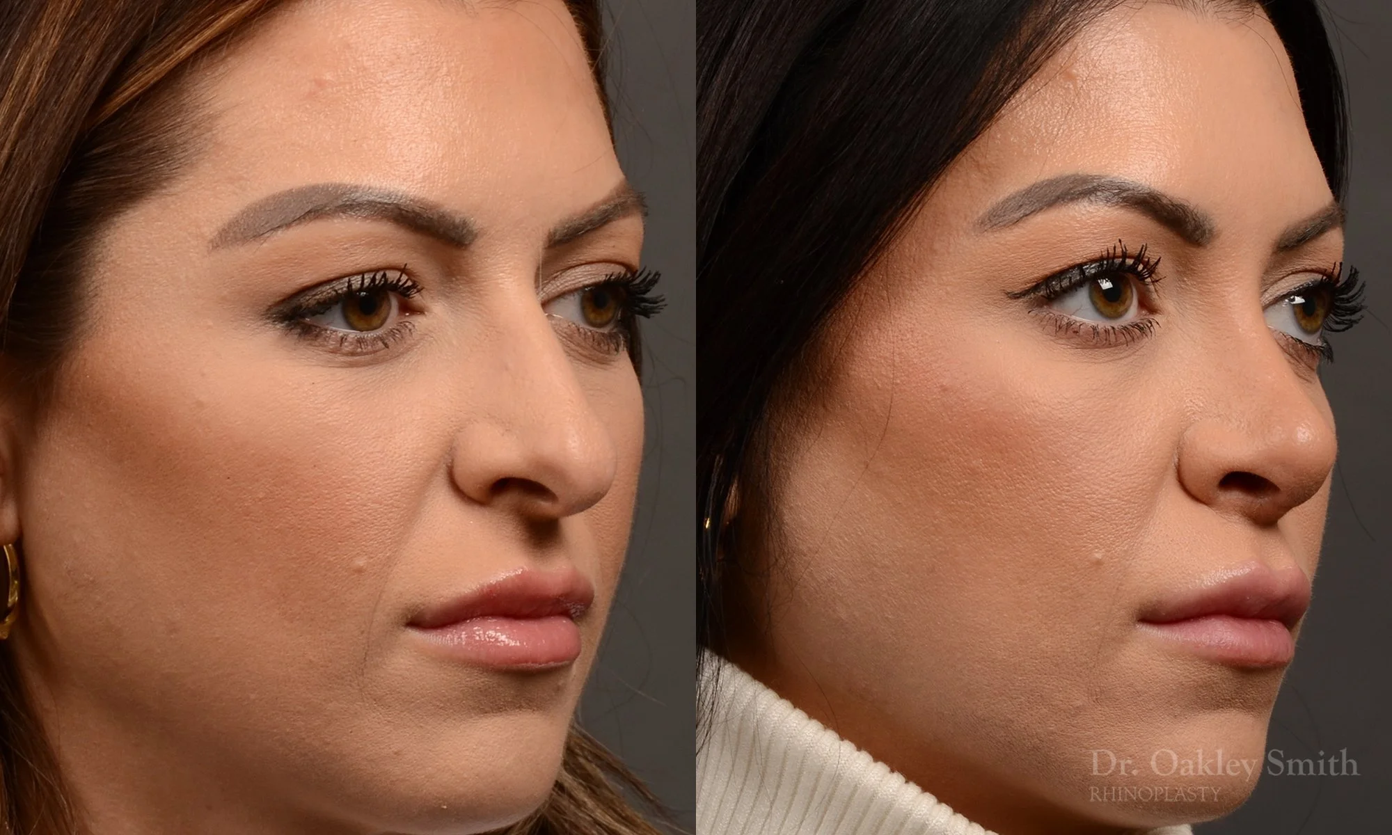 524B-rhinoplasty-dr-oakley-smith-toronto-top-surgeon-nose-job.jpg