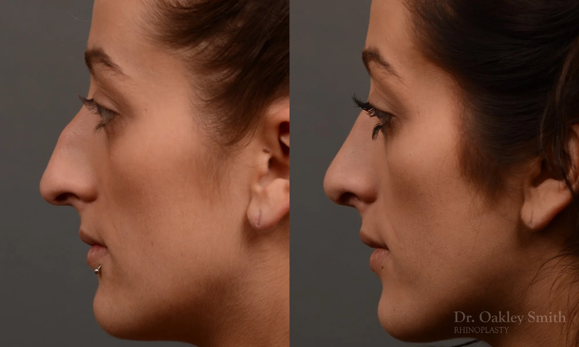 316E-rhinoplasty-dr-oakley-smith-toronto-nose-job.jpg