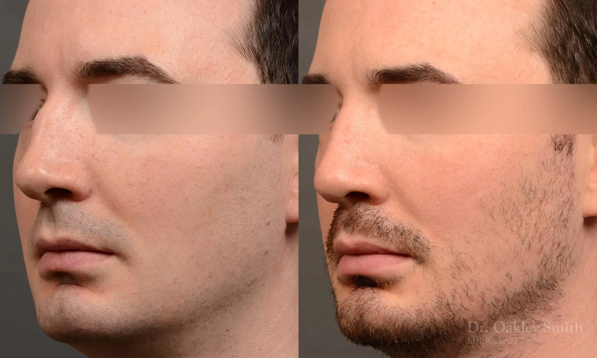 555D male rhinoplasty, nose job, toronto nose surgeon, dr oakley smith.jpg