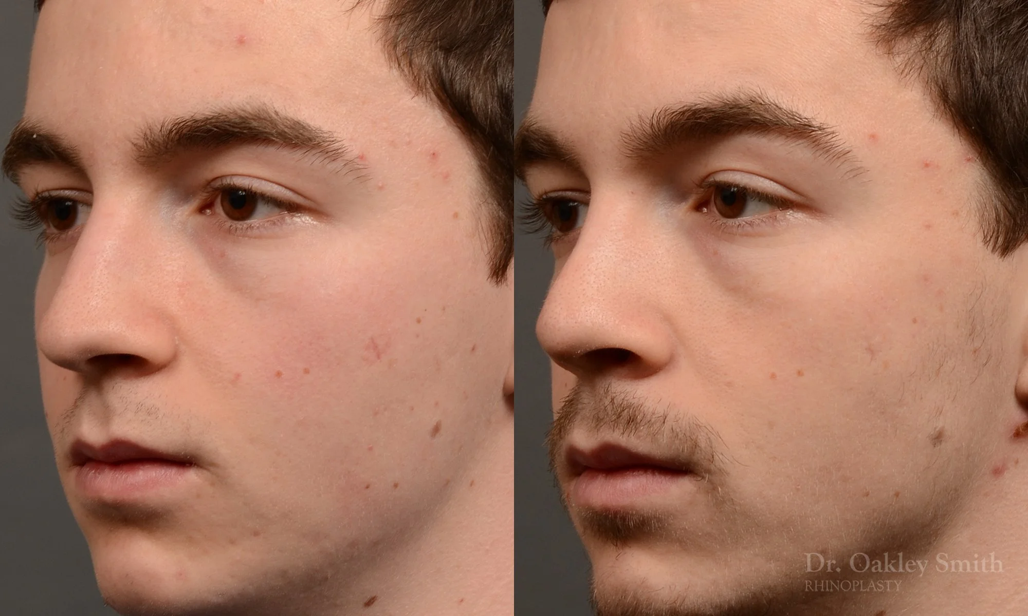 403D-male-rhinoplasty-dr-oakley-smith-toronto-nose-job.jpg