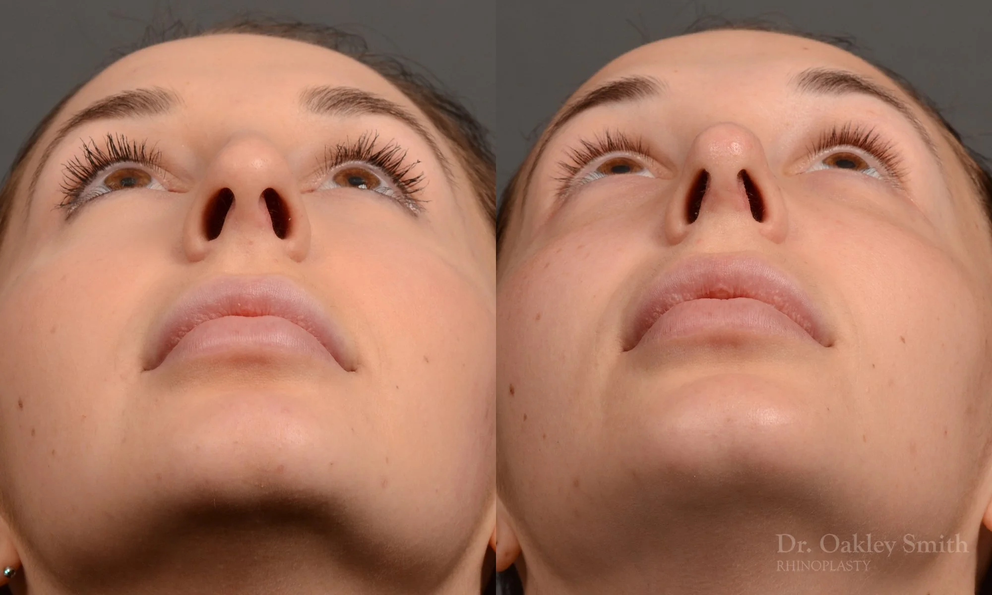 294F-rhinoplasty-dr-oakley-smith-toronto-nose-job.jpg