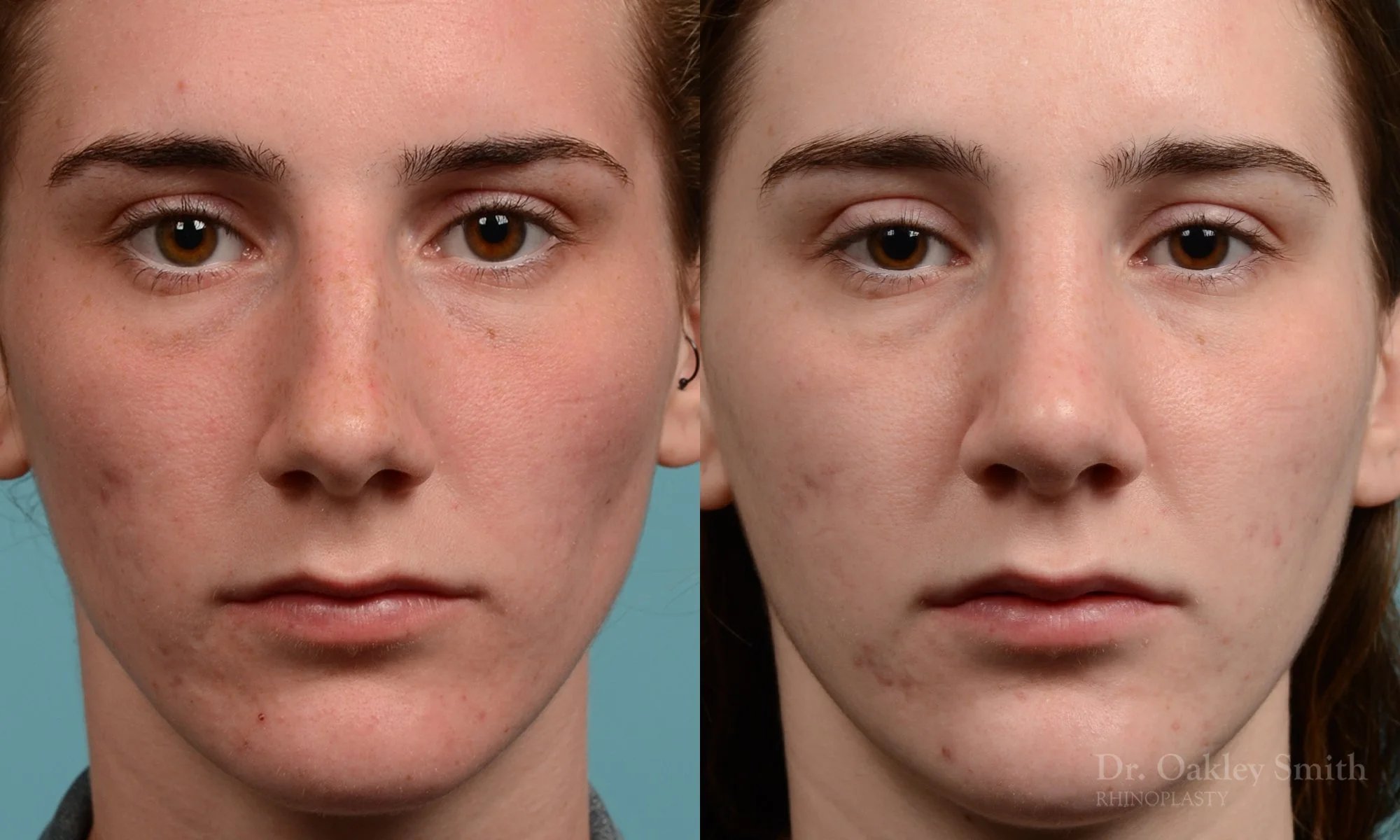 248A-rhinoplasty-dr-oakley-smith-toronto-nose-job.jpg
