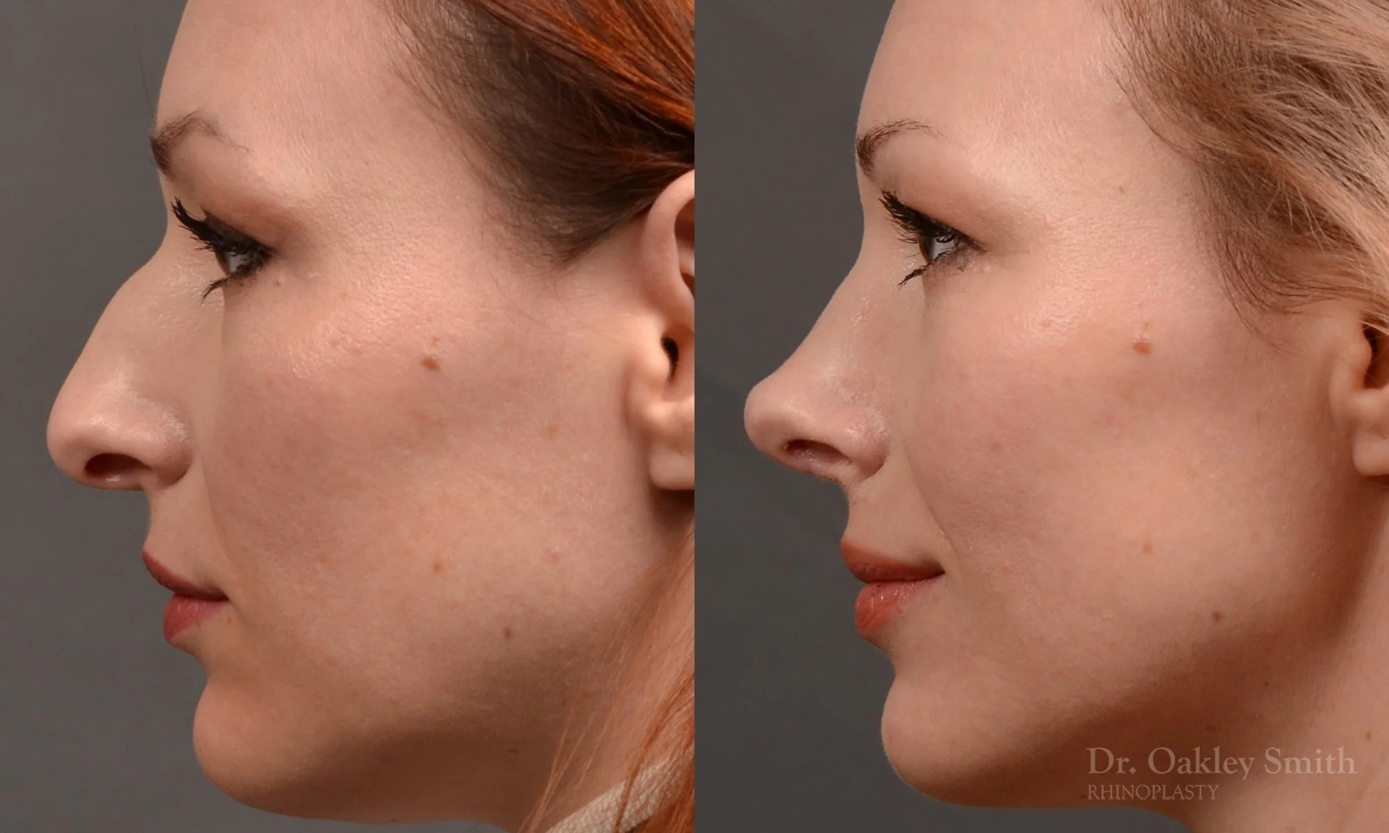 472E-rhinoplasty-dr-oakley-smith-toronto-top-surgeon-nose-job.jpg