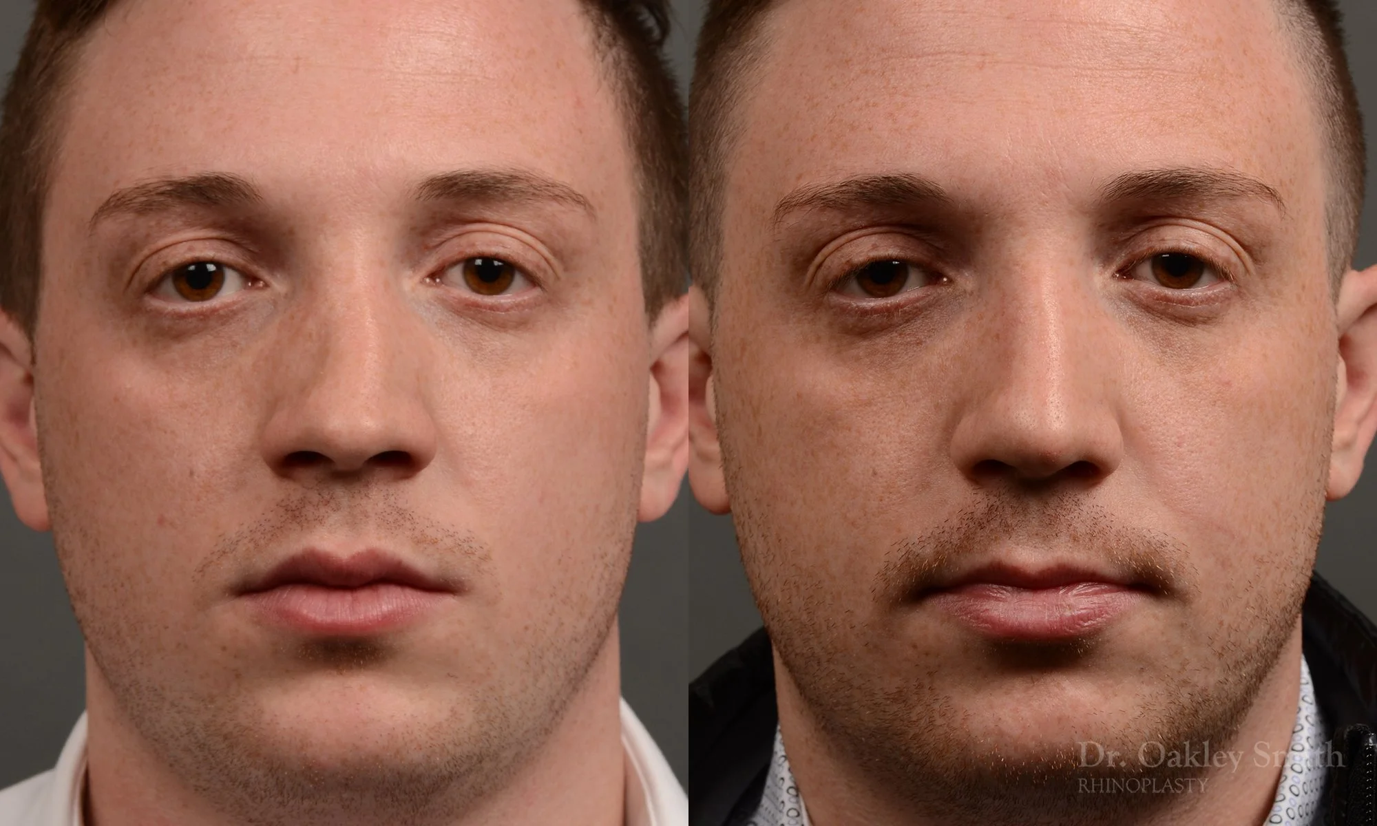 369: Primary Male Rhinoplasty, Normal Skin, Crooked