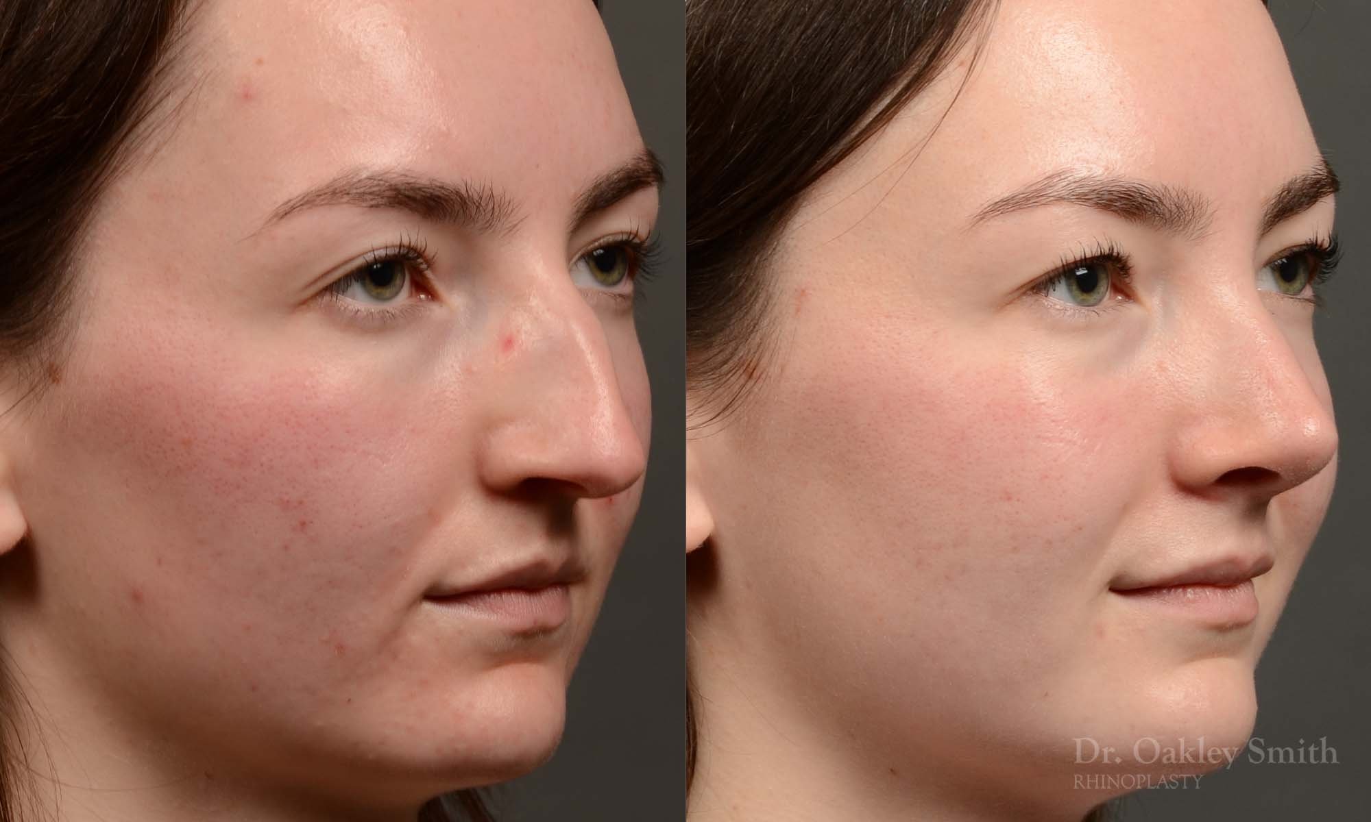 Case 501 Dr. Oakley Smith, preservation rhinoplasty, 12 months after surgery, right oblique view