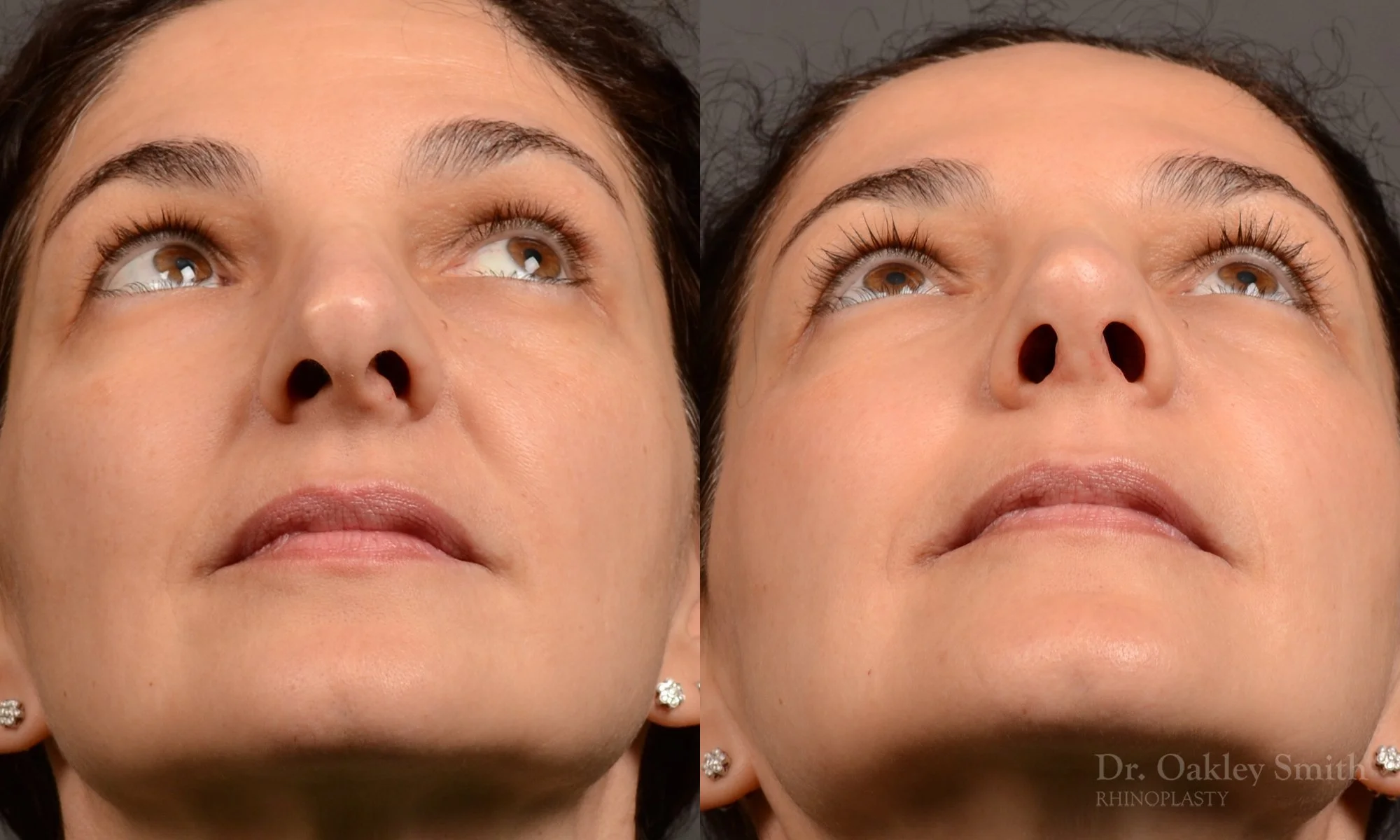 512F-rhinoplasty-dr-oakley-smith-toronto-top-surgeon-nose-job.jpg