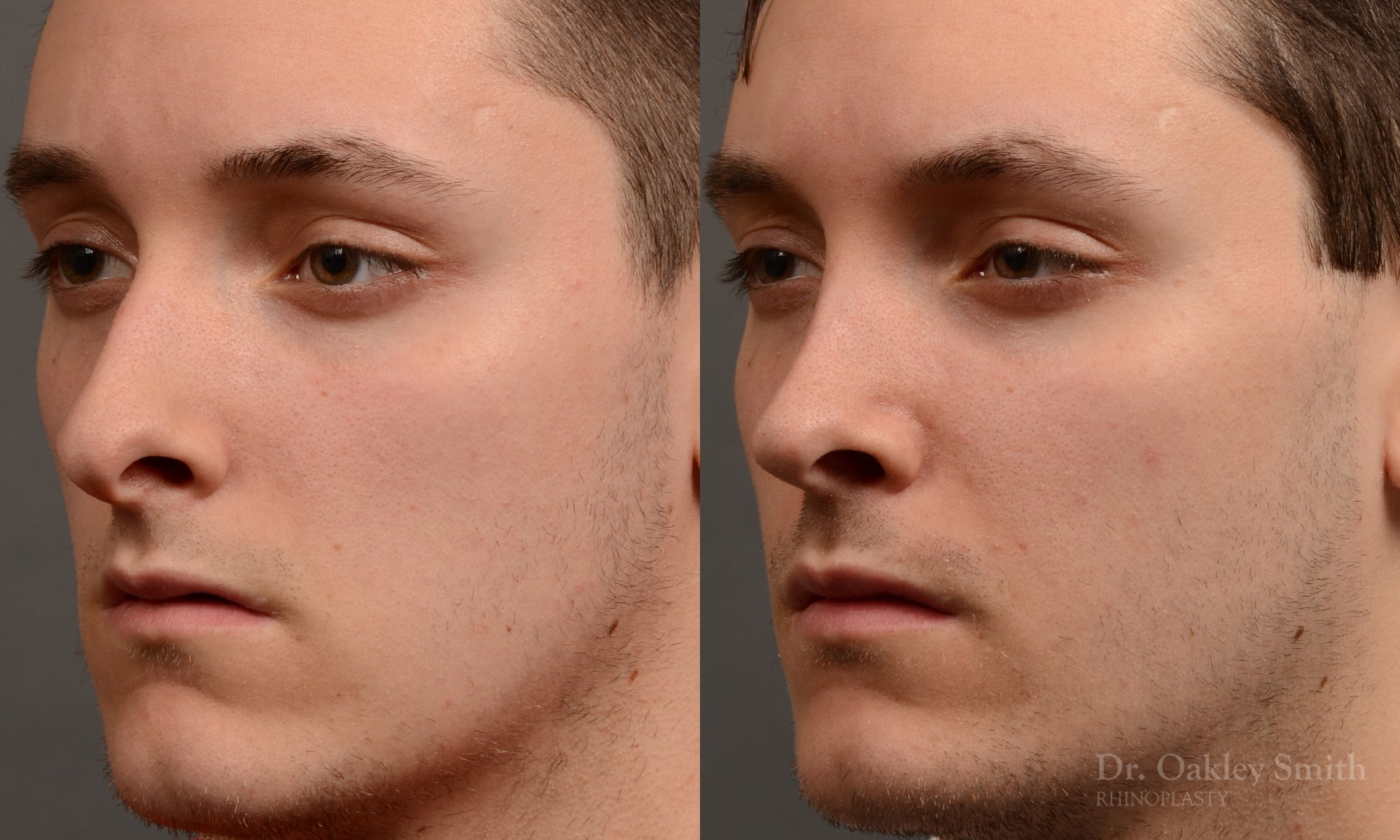 377.1D-rhinoplasty-dr-oakley-smith-toronto-nose-job.jpg