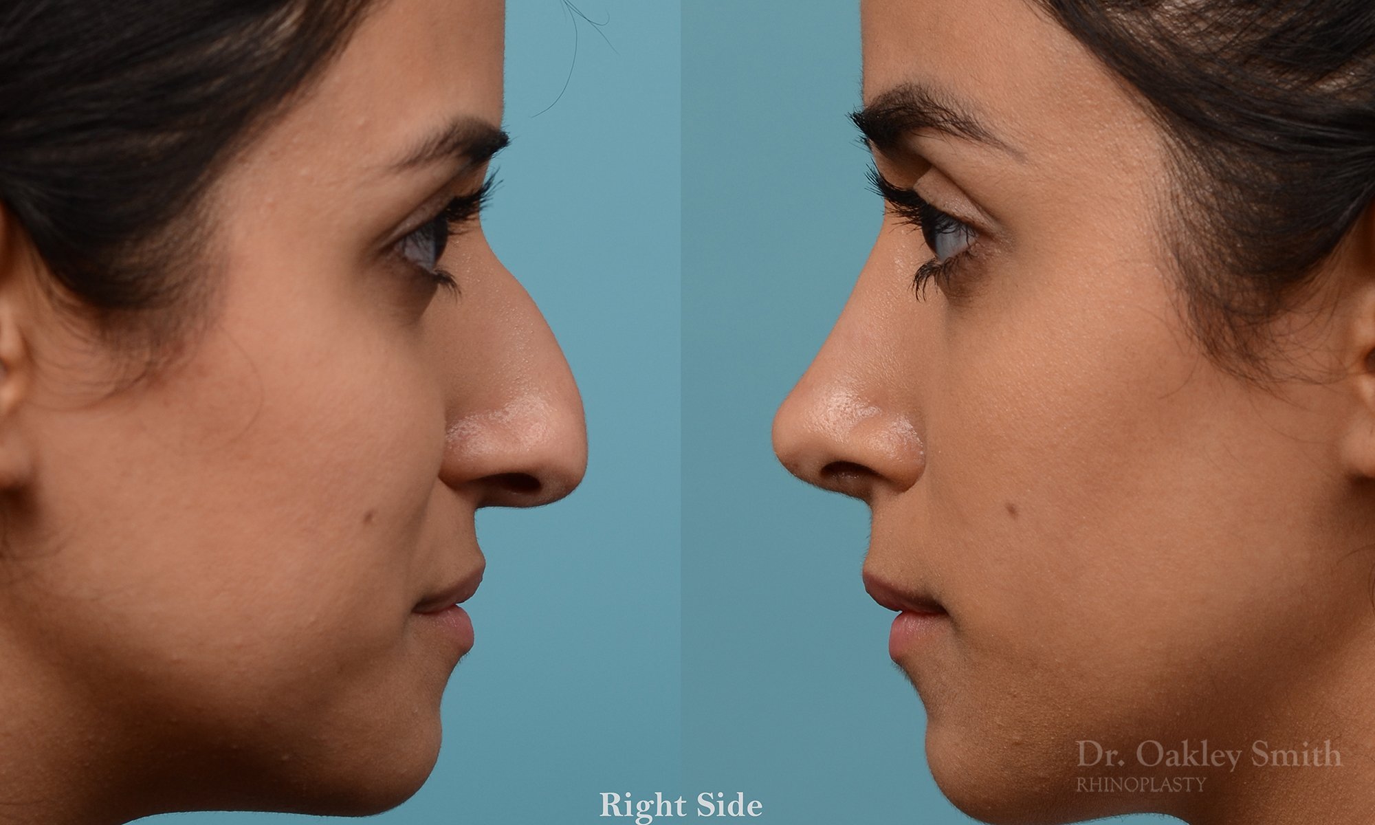 228C-nose-job-rhinoplasty-dr-oakley-smith-toronto-bump-on-the-nose-bridge-bump-4.jpg
