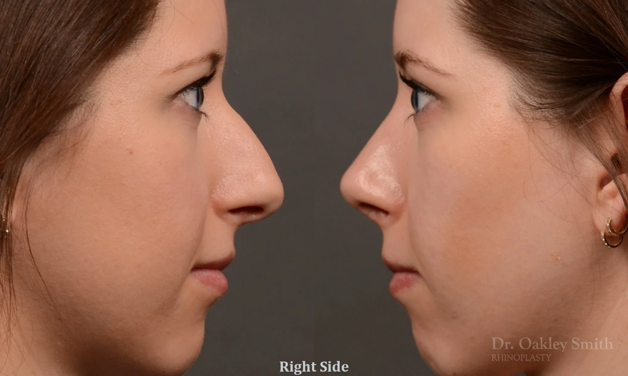 516C-rhinoplasty-dr-oakley-smith-toronto-top-surgeon-nose-job.jpg