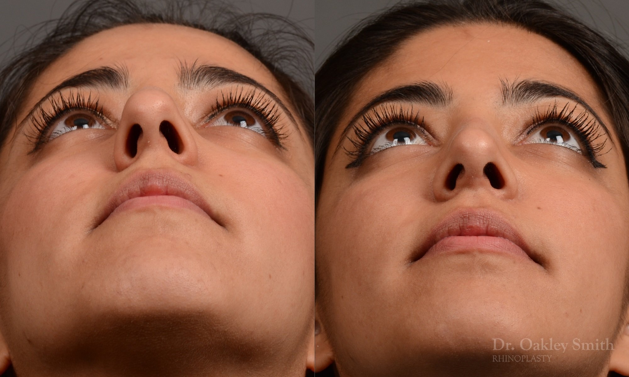 296.5F-rhinoplastydr-oakley-smith-toronto-nose-job.jpg