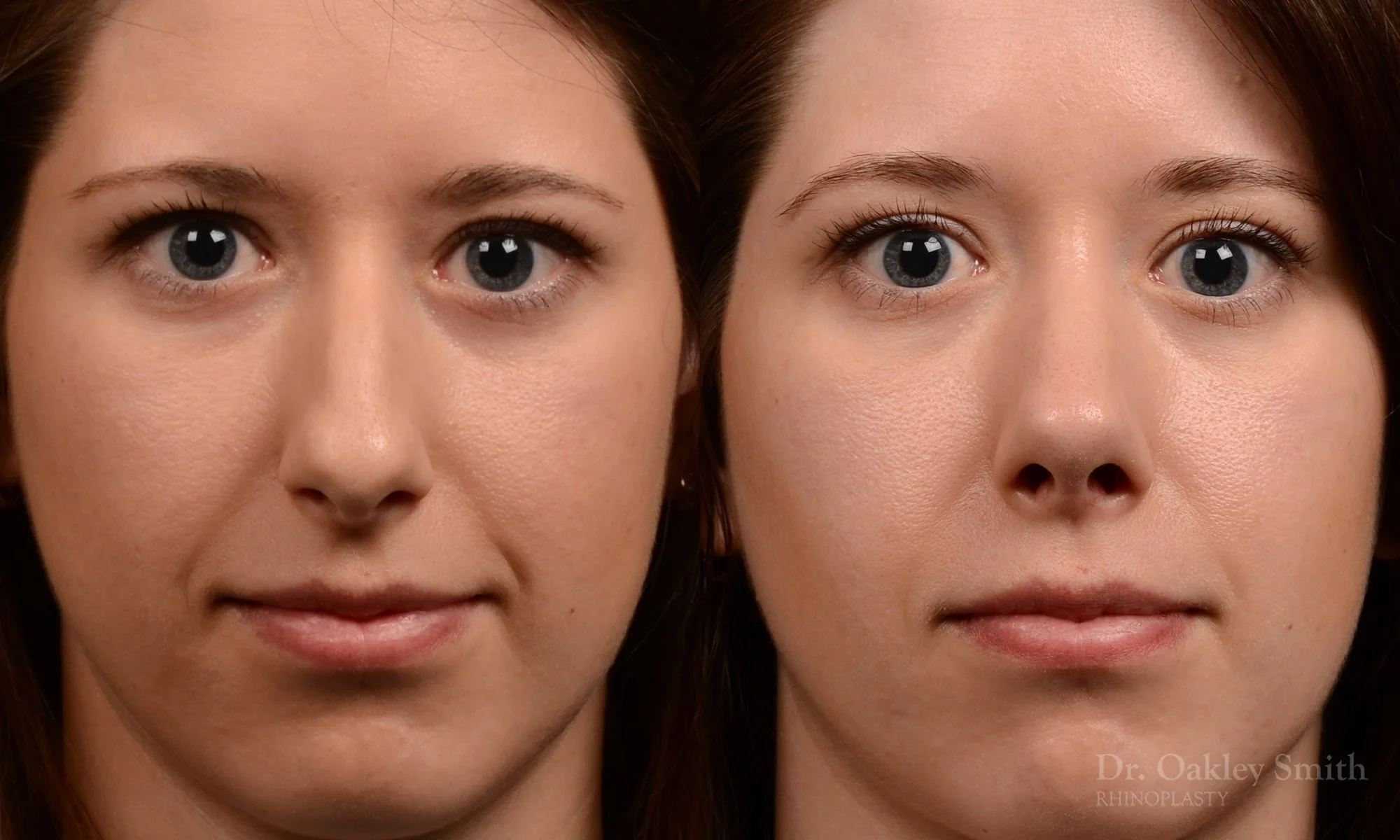 516A-rhinoplasty-dr-oakley-smith-toronto-top-surgeon-nose-job.jpg