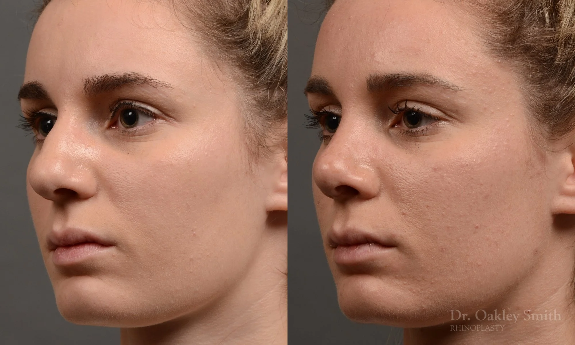 358D-rhinoplasty-dr-oakley-smith-toronto-nose-job.jpg