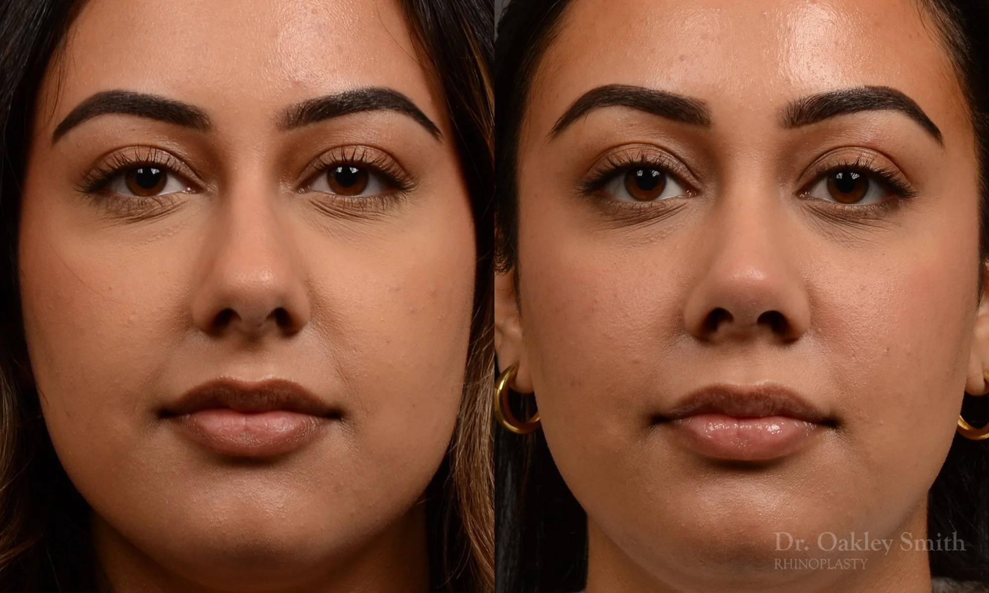 523A-rhinoplasty-dr-oakley-smith-toronto-top-surgeon-nose-job.jpg.jpg