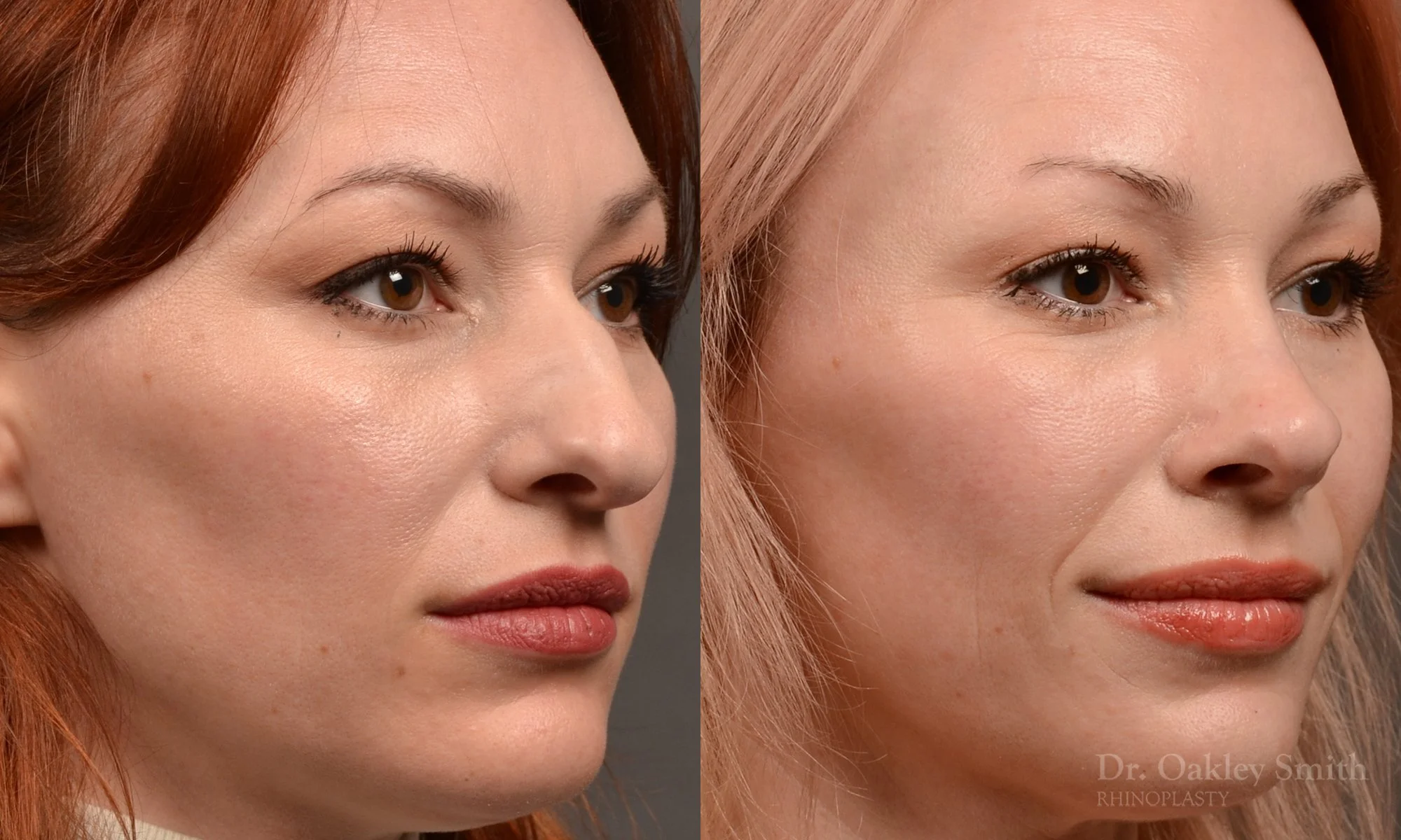 472B-rhinoplasty-dr-oakley-smith-toronto-top-surgeon-nose-job.jpg