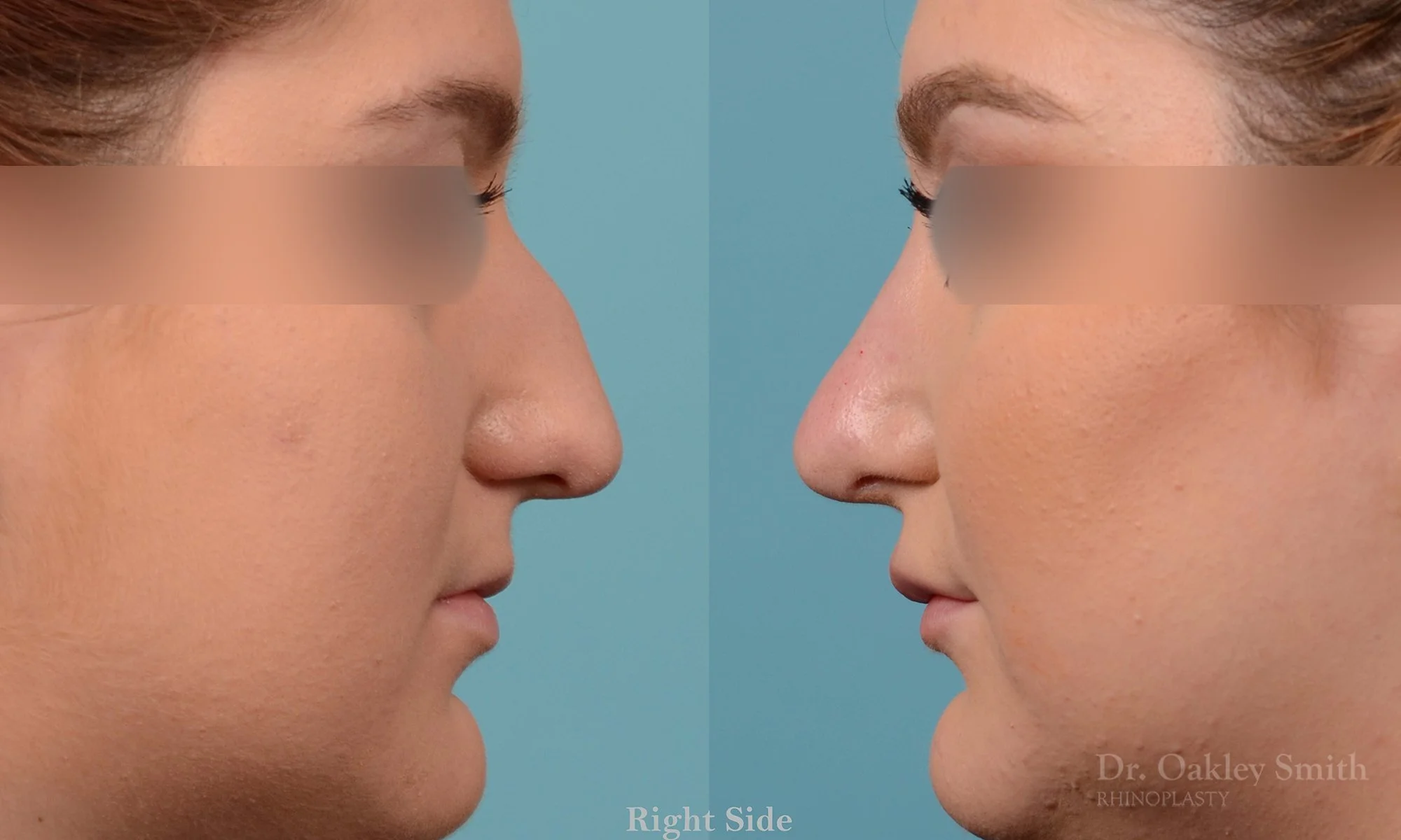 235: Female, Ethnic Rhinoplasty, Thick Skin, Dorsal Hump, Crooked