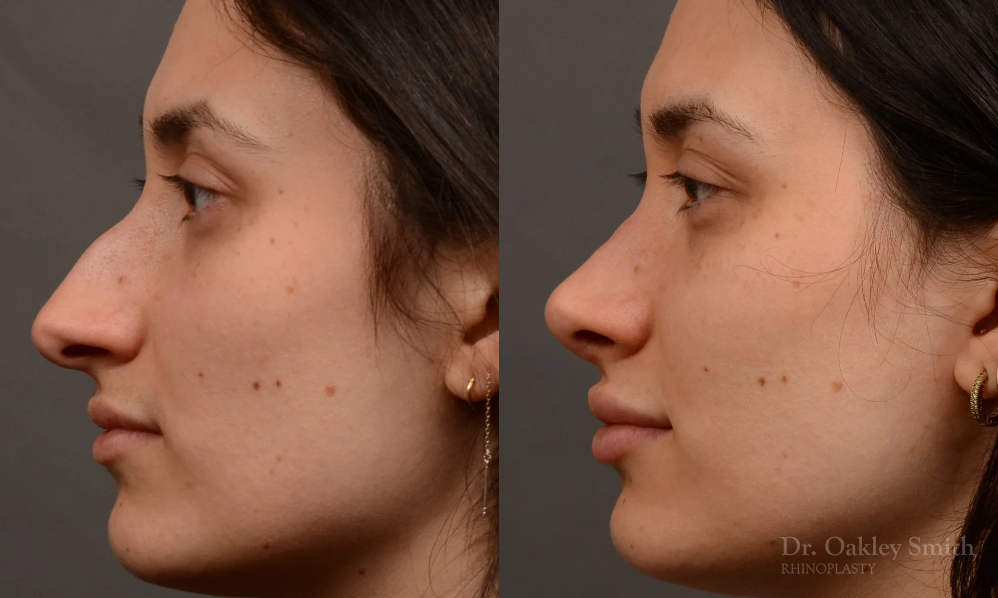 506E-rhinoplasty-dr-oakley-smith-toronto-top-surgeon-nose-job.jpg