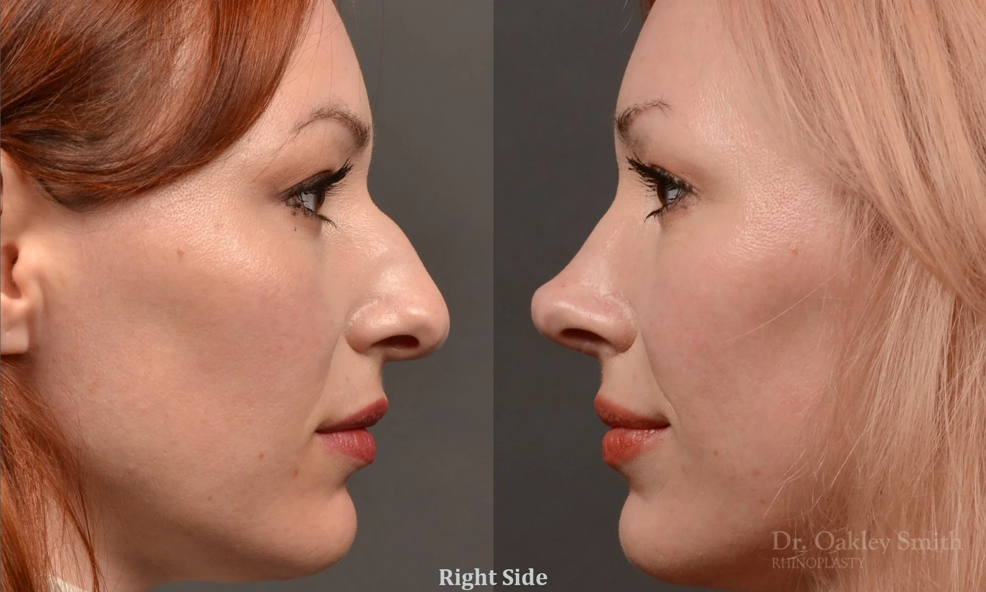 472C-rhinoplasty-dr-oakley-smith-toronto-top-surgeon-nose-job.jpg