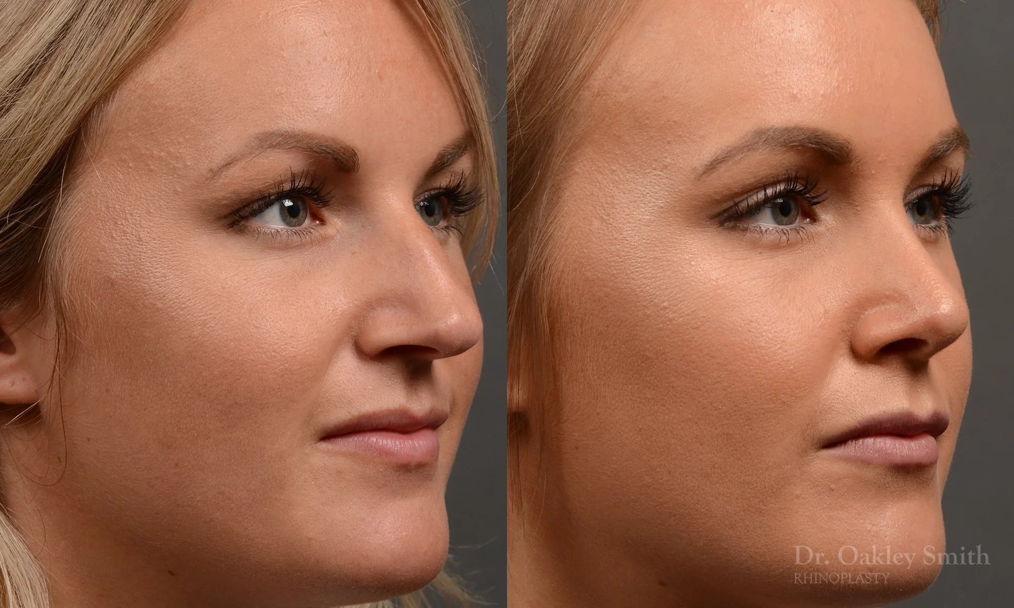 336B-rhinoplasty-dr-oakley-smith-toronto-nose-job.jpg