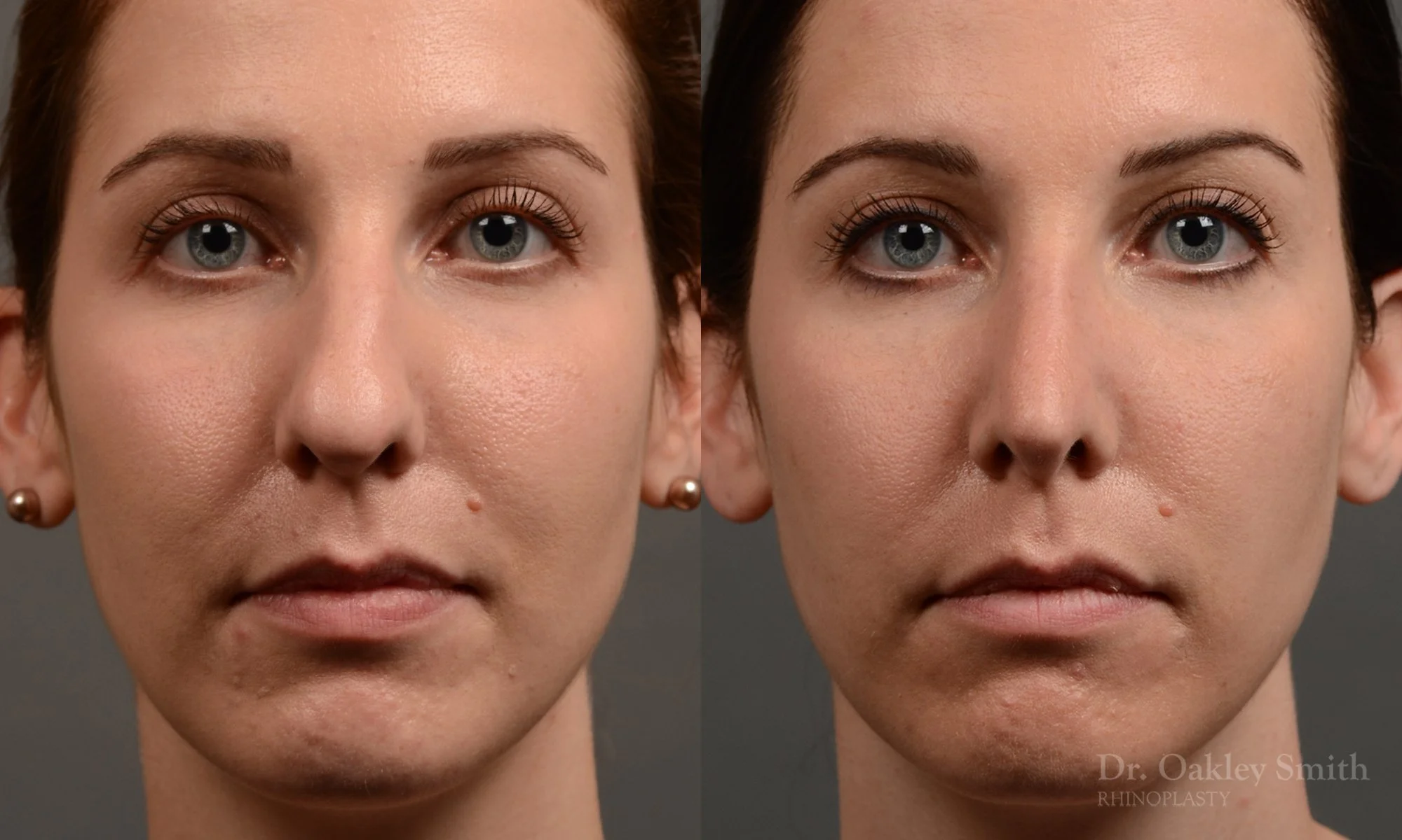 357A-rhinoplasty-dr-oakley-smith-toronto-nose-job - Copy.jpg