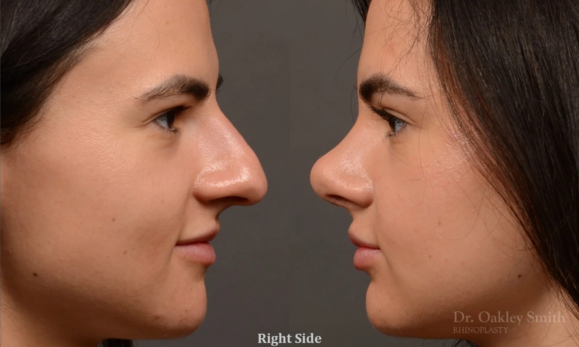 509: Female, Ethnic Rhinoplasty, Large Noae, Thick Skin, Tip Rotation