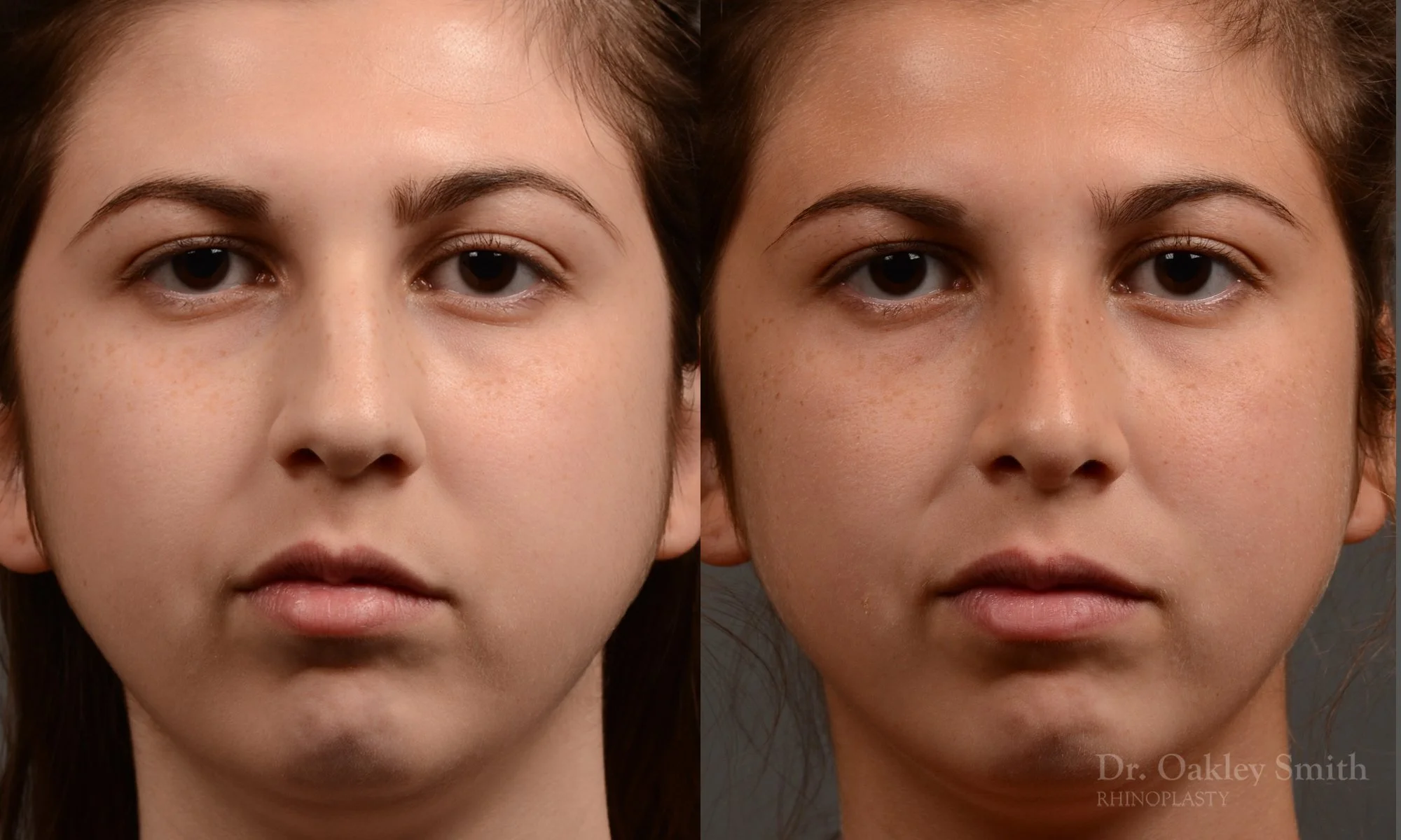371A-rhinoplasty-dr-oakley-smith-toronto-nose-job.jpg