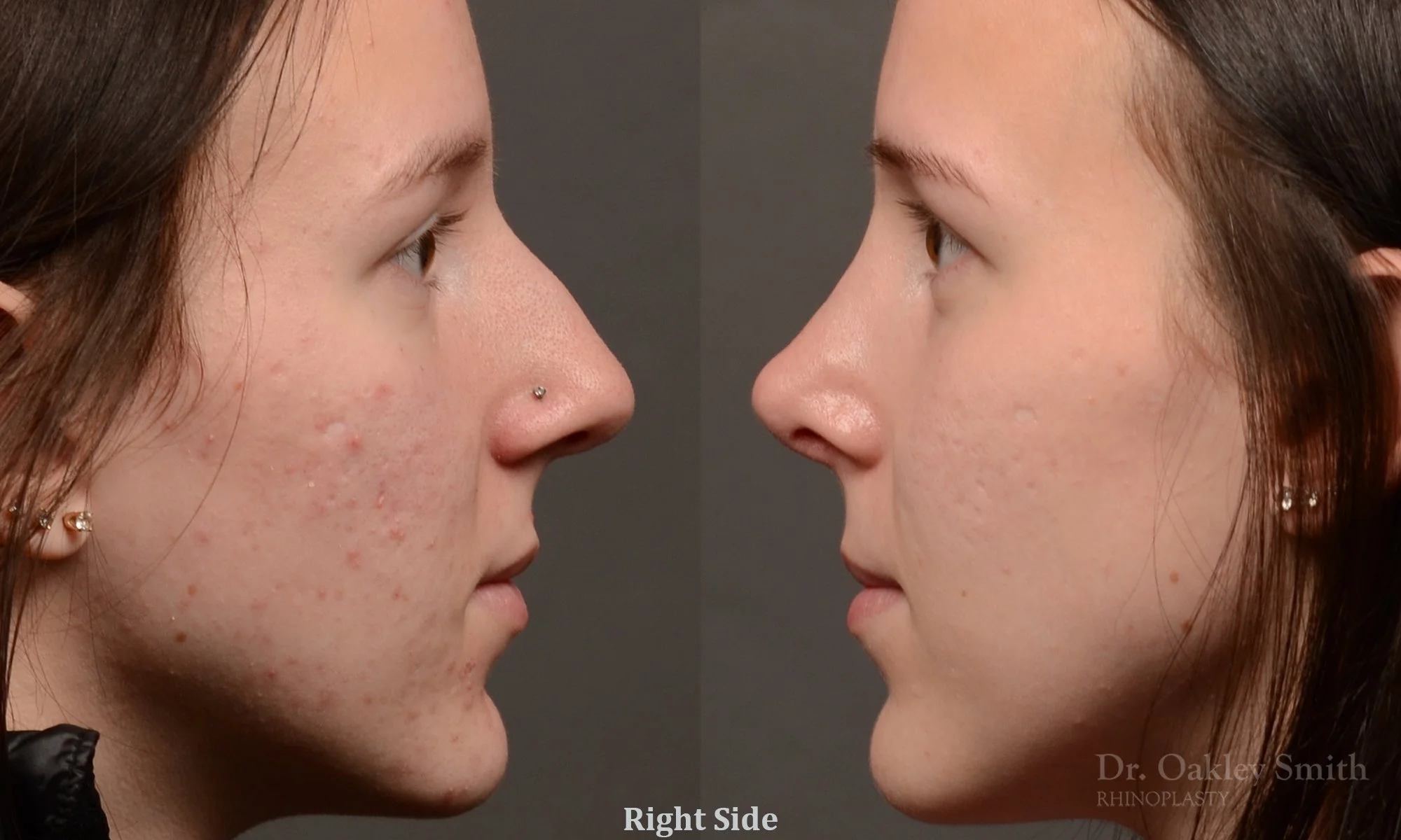 511: Female, Primary Rhinoplasty, Normal Skin, Bridge Work, Tip Work